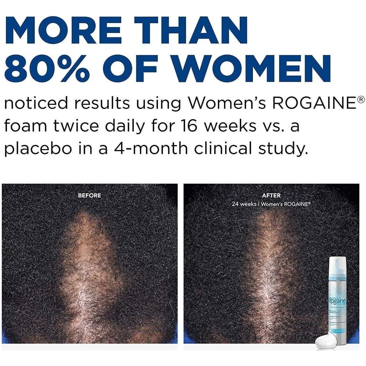 Rogaine Women’s 5% Minoxidil Foam – 60ml | Once-A-Day Hair Regrowth Treatment (2-Month Supply) Rogaine Woman's 5% Minoxidil Foam, Topical Once - A - Day Hair Loss Treatment - 60ml (2 Month Supply) - Glam Global UKRogaine