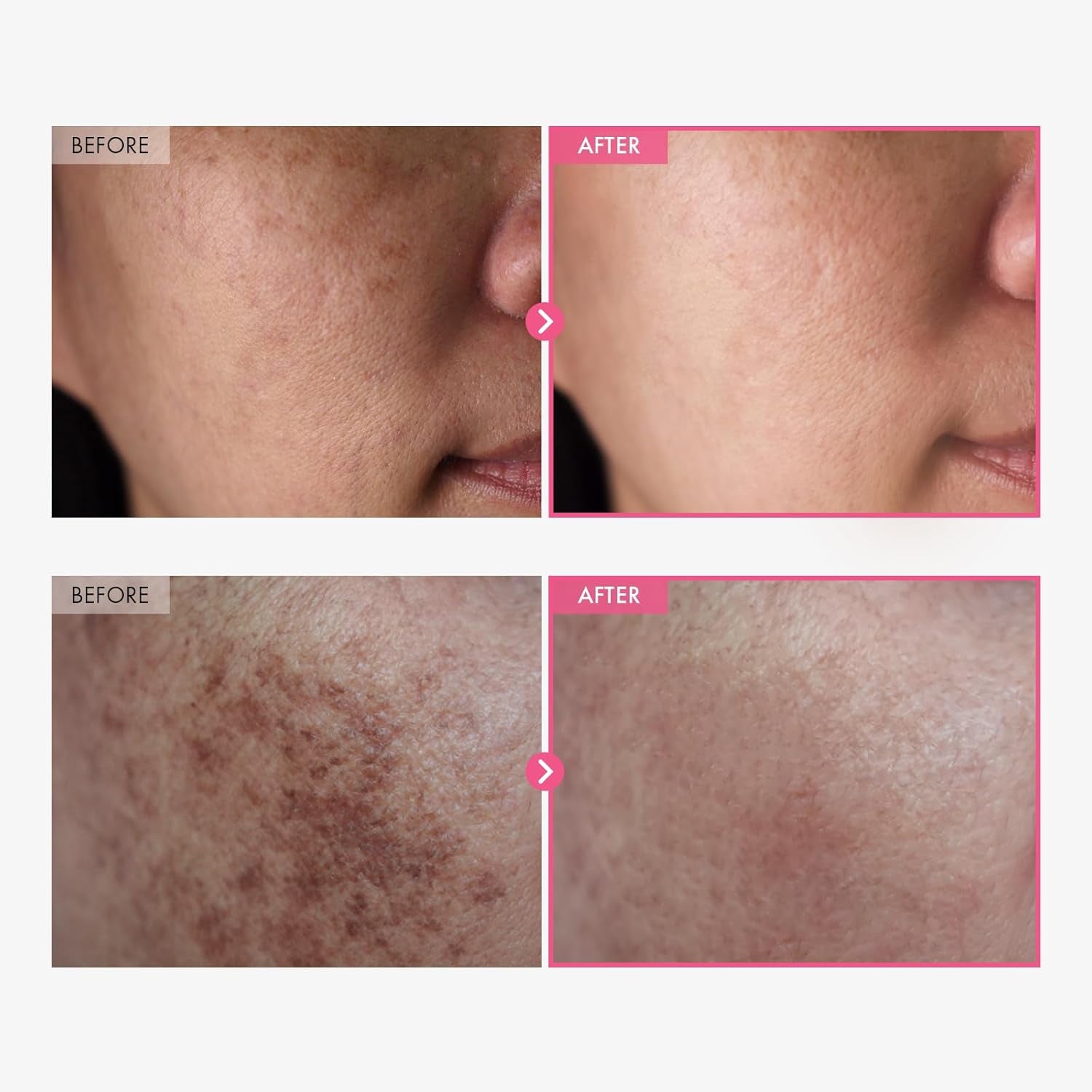 TOSOWOONG Arbutin 7.0 + TXA 4.0 Cream – 50ml | Brightening & Dark Spot Correcting Cream for Even Skin Tone TOSOWOONG Arbutin 7.0 + TXA 4.0 Cream – 50ml | Brightening & Dark Spot Correcting Cream for Even Skin Tone