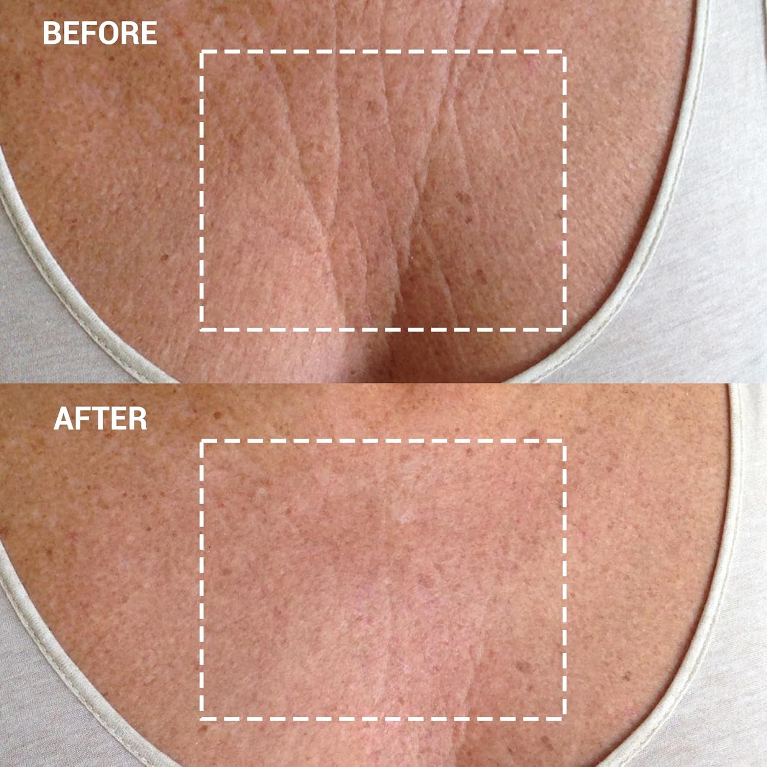 Wrinkles Schminkles Chest Wrinkle Patch – 1 Pack | Reusable Medical Grade Silicone for Smoother, Younger-Looking Skin Wrinkles Schminkles Chest Wrinkle Patch – 1 Pack | Reusable Medical Grade Silicone for Smoother, Younger-Looking Skin