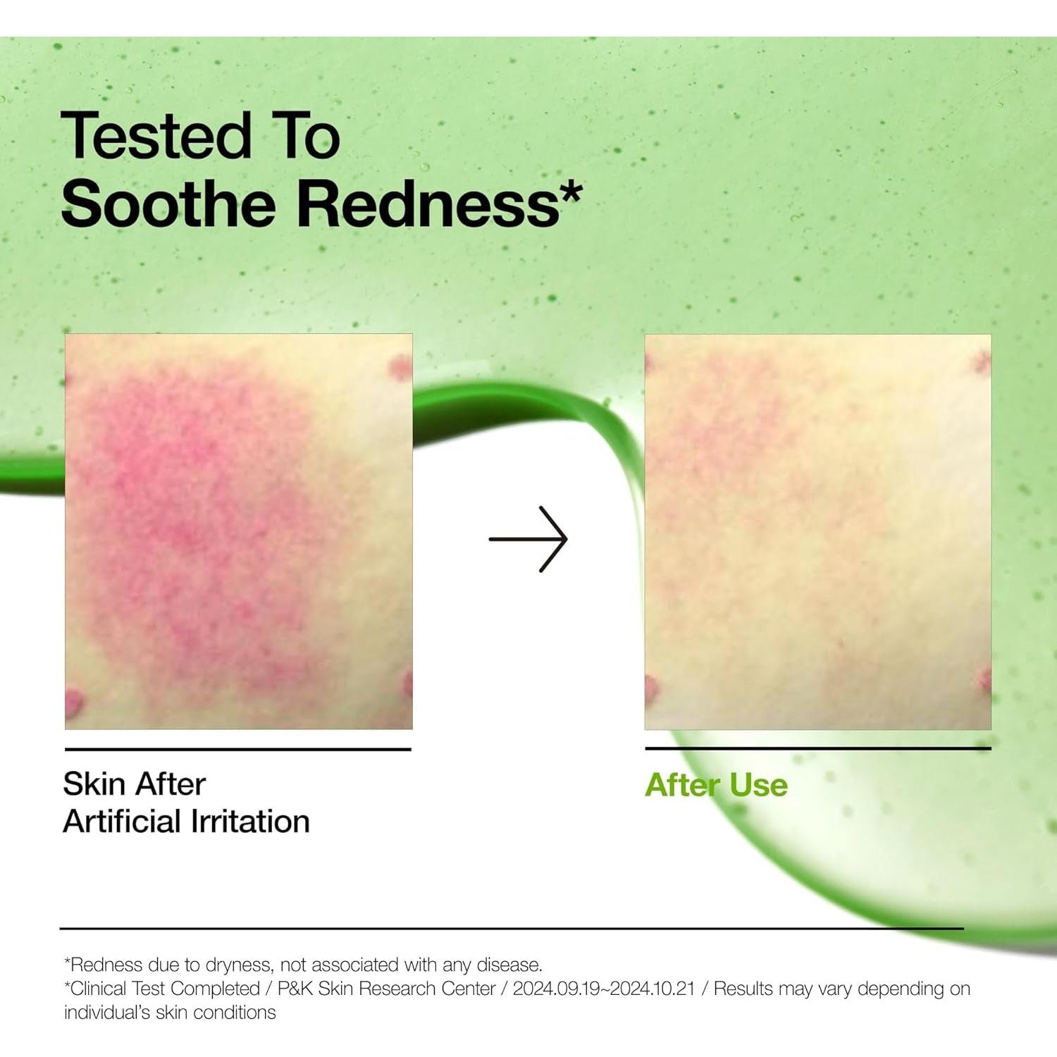 Anua 10+ Azelaic Acid + Hyaluron Redness Soothing Serum – 30ml | Soothes Redness & Hydrates Sensitive Skin Anua 10+  | Azelaic Acid 10+ Hyaluron | Redness Soothing Serum 1.01 Fl Oz - 30ml