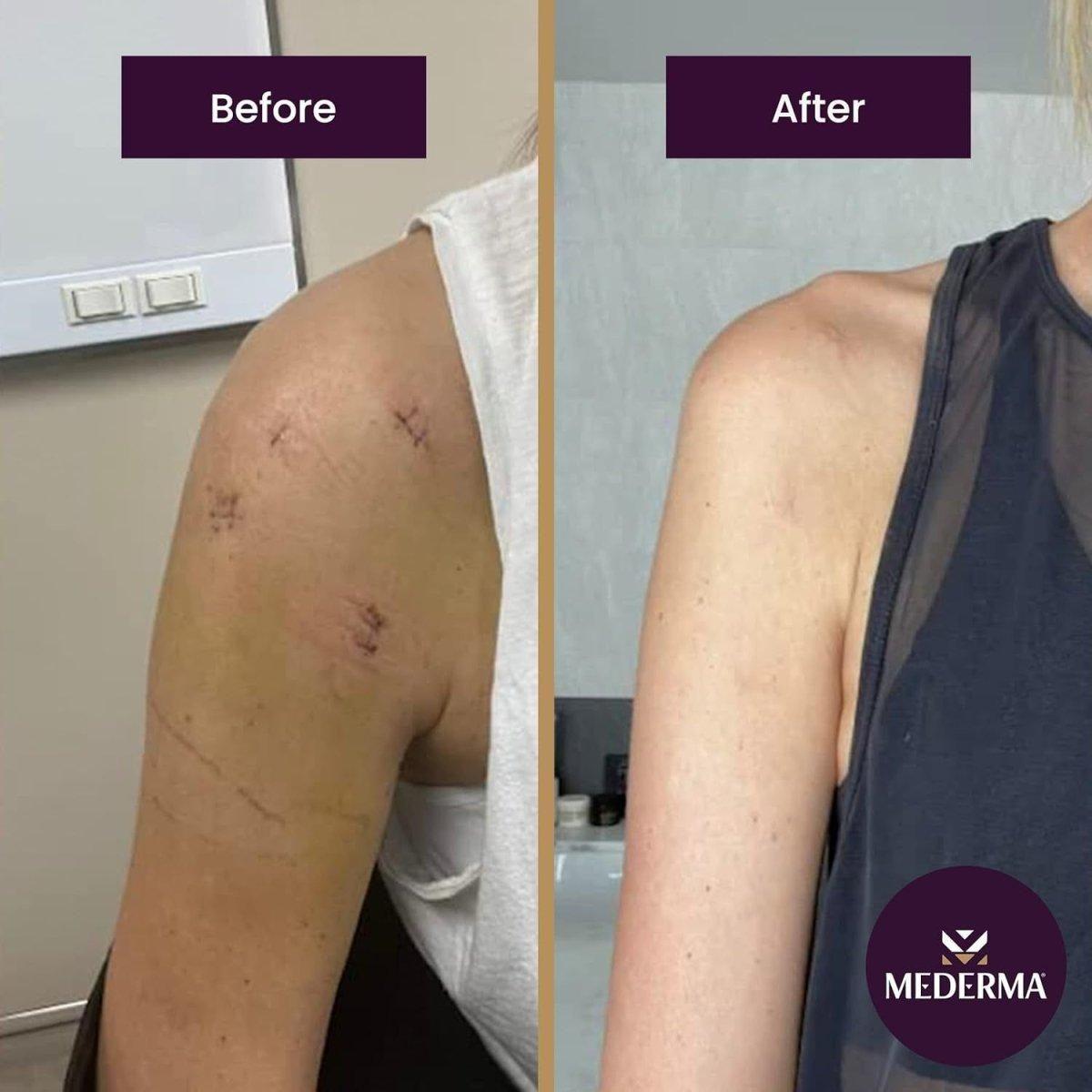 Mederma Advanced Scar Gel – 50ml | Clinically Proven Scar Treatment for Acne, Surgery, Burns & Injury Mederma Advanced Scar Gel - 50ml - Glam Global UKMederma