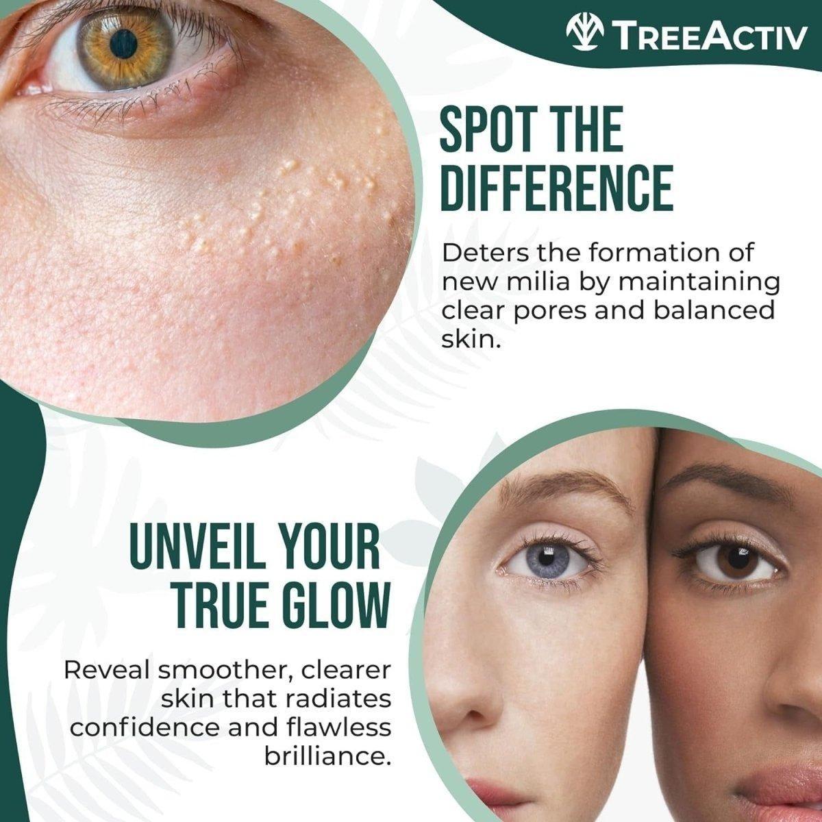 Milia & Acne Spot Treatment – 15ml | Fast-Acting Milia Removal & Skin Smoothing Solution Milia & Acne Spot Treatment 15ml - Fast - Acting Milia Removal Cream - Glam Global UKTreeActiv