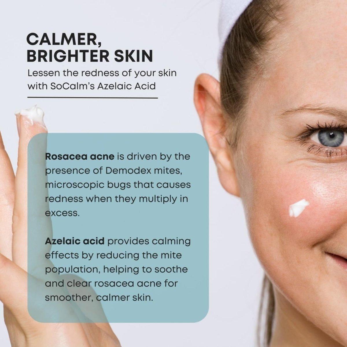 SoCalm 10% Azelaic Acid Cream – Rosacea Relief, Acne Treatment & Scar Improvement (1 fl oz / 30ml) SoCalm 10% Azelaic Acid 1 fl oz - 30 ml - Glam Global UKSoCalm