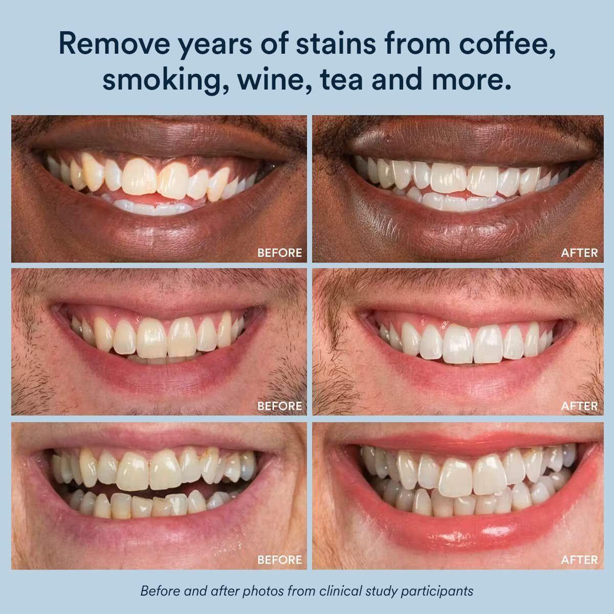 Auraglow Teeth Whitening Kit – LED Accelerator Light & 35% Carbamide Peroxide Gel | 20+ Professional Whitening Treatments Auraglow Teeth Whitening Kit, LED Accelerator Light, 35% Carbamide Peroxide Teeth Whitening Gel, 20+ Whitening Treatments, (2) 5Ml Whitening Gel Syringes - Glam Global UKAuraglow