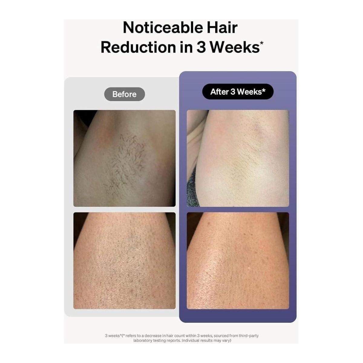 Ulike Air 3 IPL Laser Hair Removal Device | Ice-Cooling Technology for Painless, At-Home Hair Reduction Ulike Laser Hair Removal, Air 10 IPL - Glam Global UKUlike