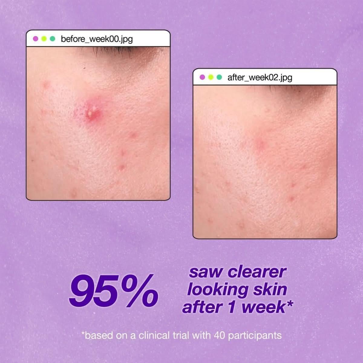 Dermalogica Breakout Clearing Liquid Peel – 30ml | Exfoliator for Clearer, Smoother Skin Dermalogica Breakout Clearing Liquid Peel - 30ml - Glam Global UKDermalogica