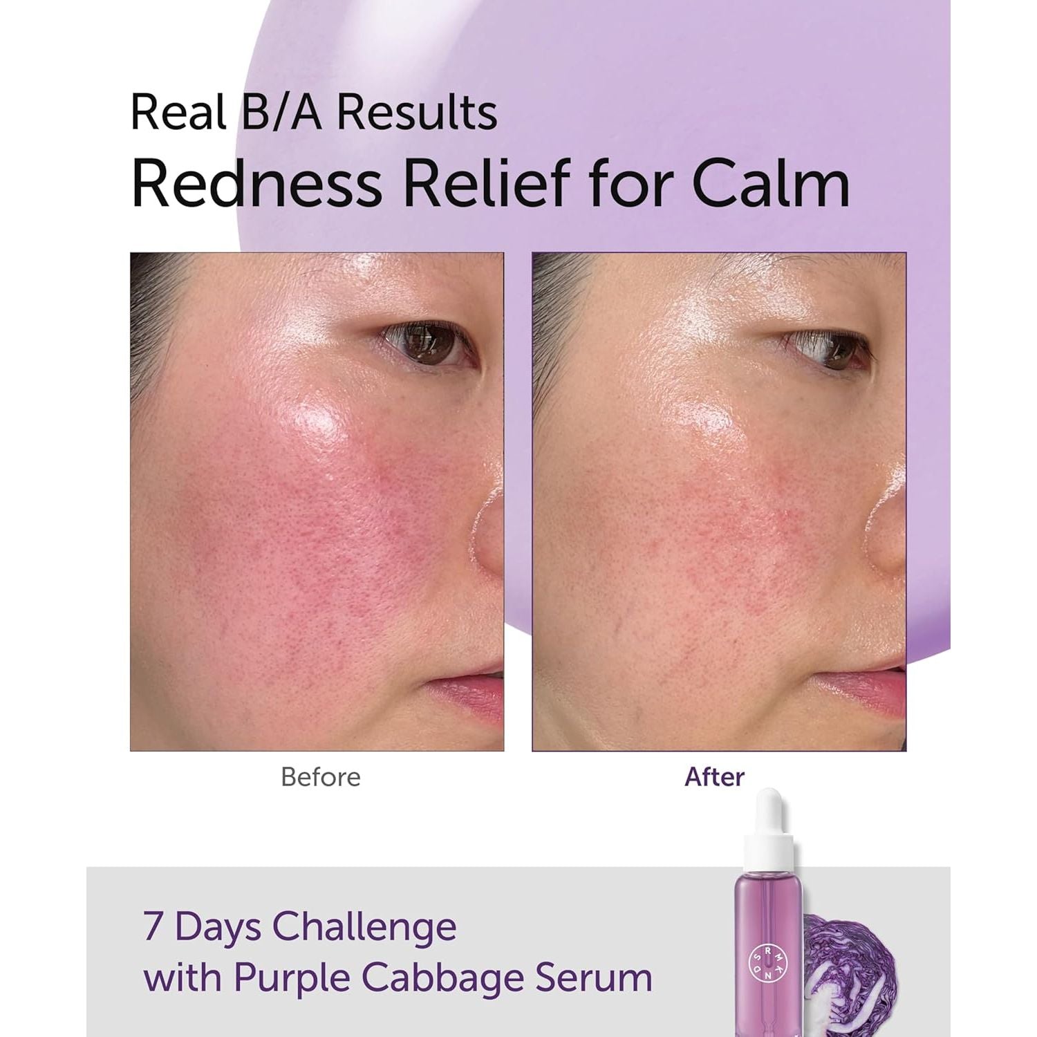 SERUMKIND Purple Cabbage Serum - Calming and Skin Recovery- Korean Face Skincare – Beta Glucan 100,000Ppm – Soothing & Redness Relief - Vegan, Cruelty-Free – 1.01 Fl.Oz.