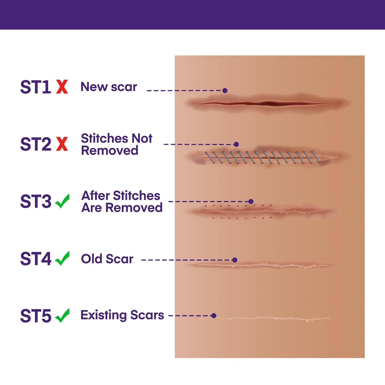 MURASAKI BEAUTY 100% Silicone Scar Gel with SPF 30 – 30g | Professional Scar Treatment for All Skin Types