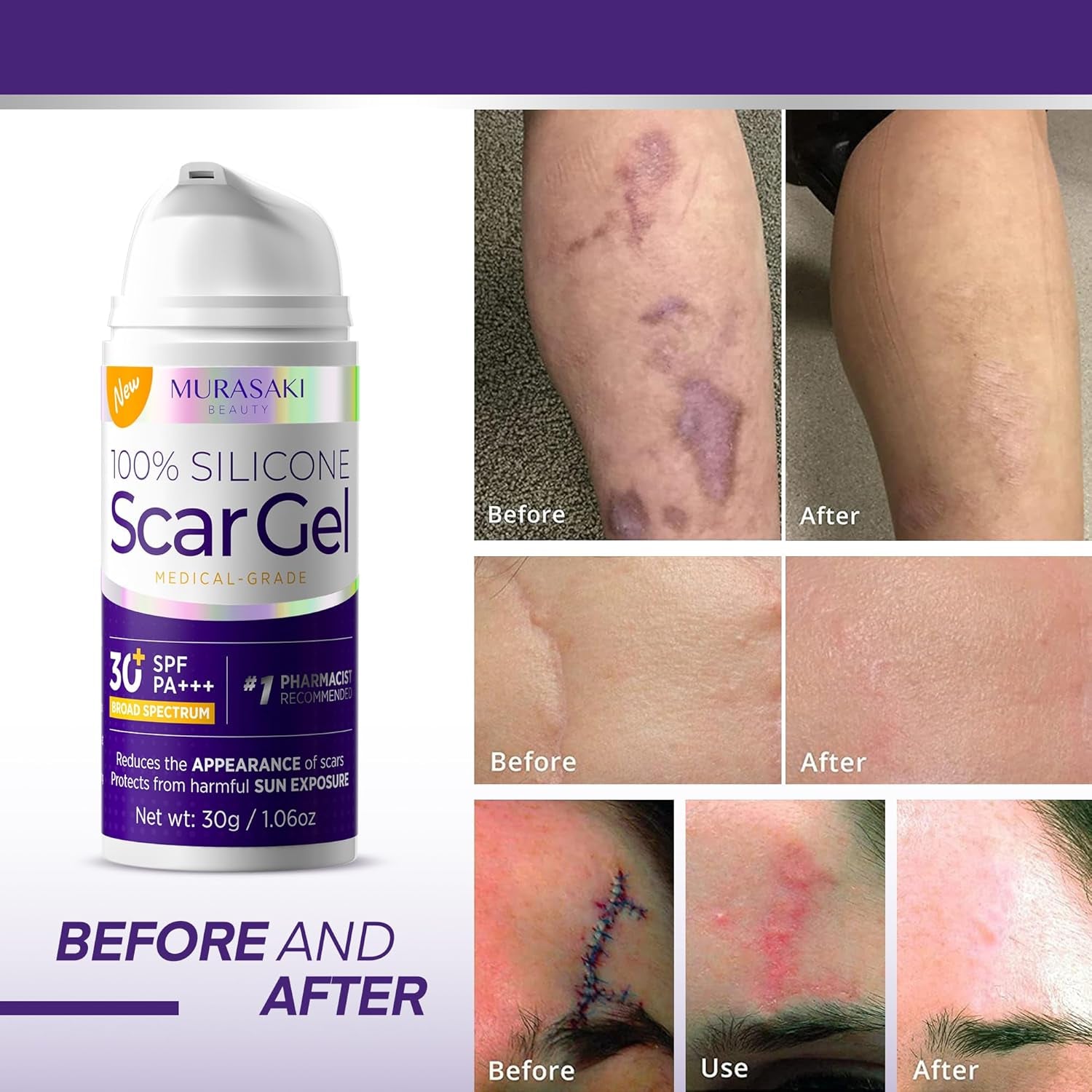 MURASAKI BEAUTY 100% Silicone Scar Gel with SPF 30 – 30g | Professional Scar Treatment for All Skin Types