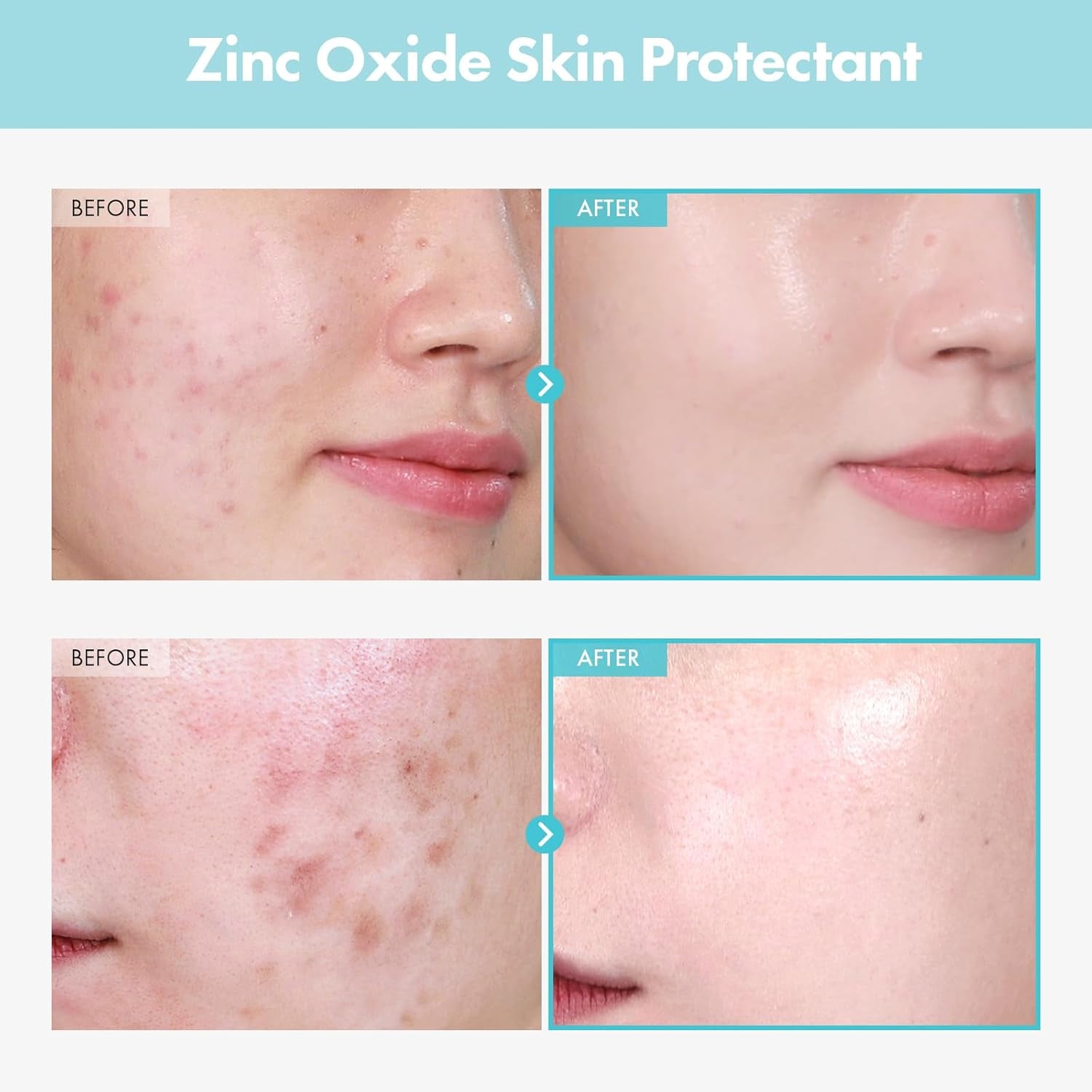 SOS Repair CICA Clinic Zinc Cream, 100,000Ppm Zinc Oxide, Heal, Soothe Acne, Redness, Rosacea Treatment, Skin Barrier Repair, Moisture, Non-Comedogenic, Korean Skincare, 50G, 1.76 Oz.