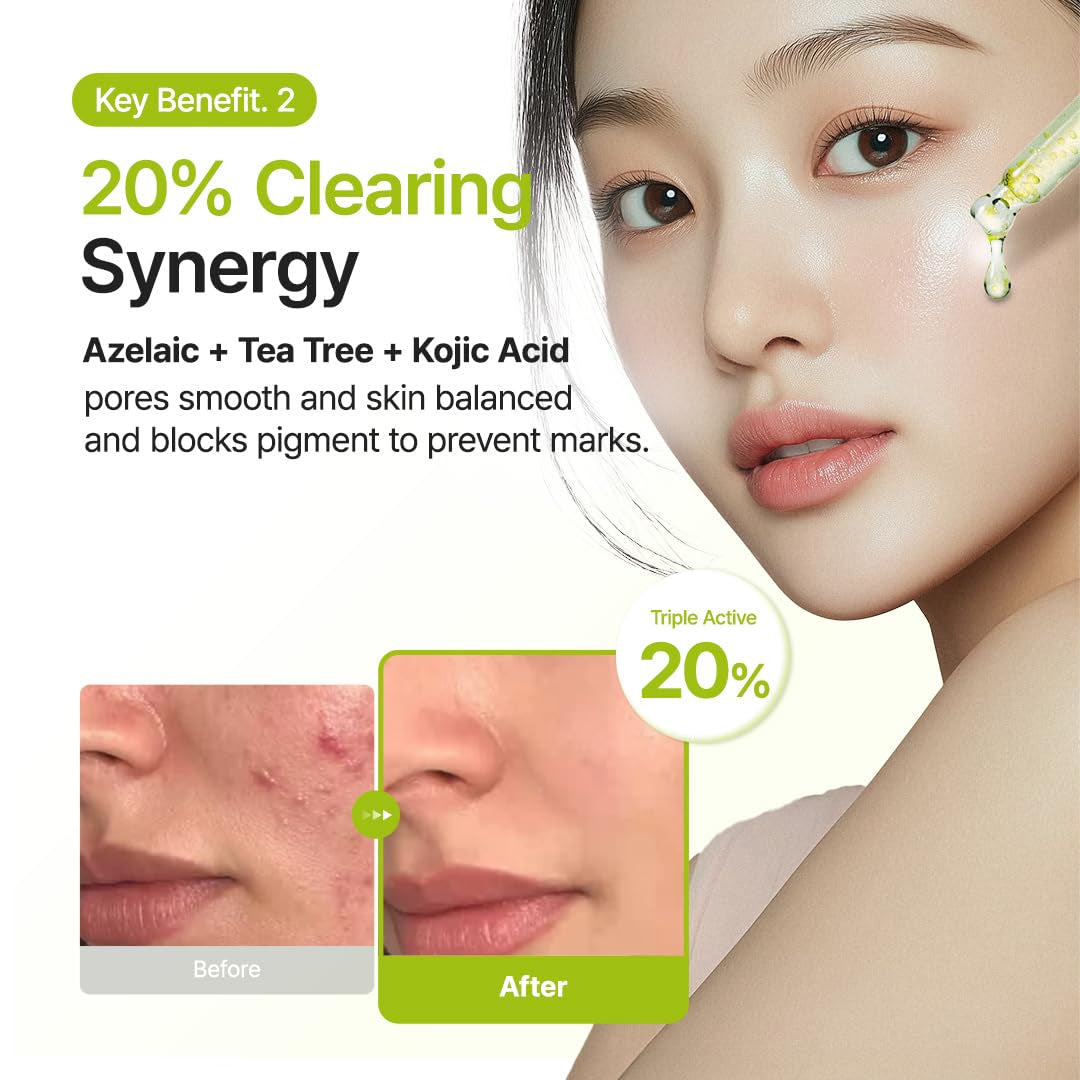 Azelaic Acid 10% + Kojic Acid + Tea Tree Facial Serum | for Acne & Marks, Breakouts | High-Level Azelaic Acid 10% | Korean Skincare, 30Ml 1.01 Fl.Oz
