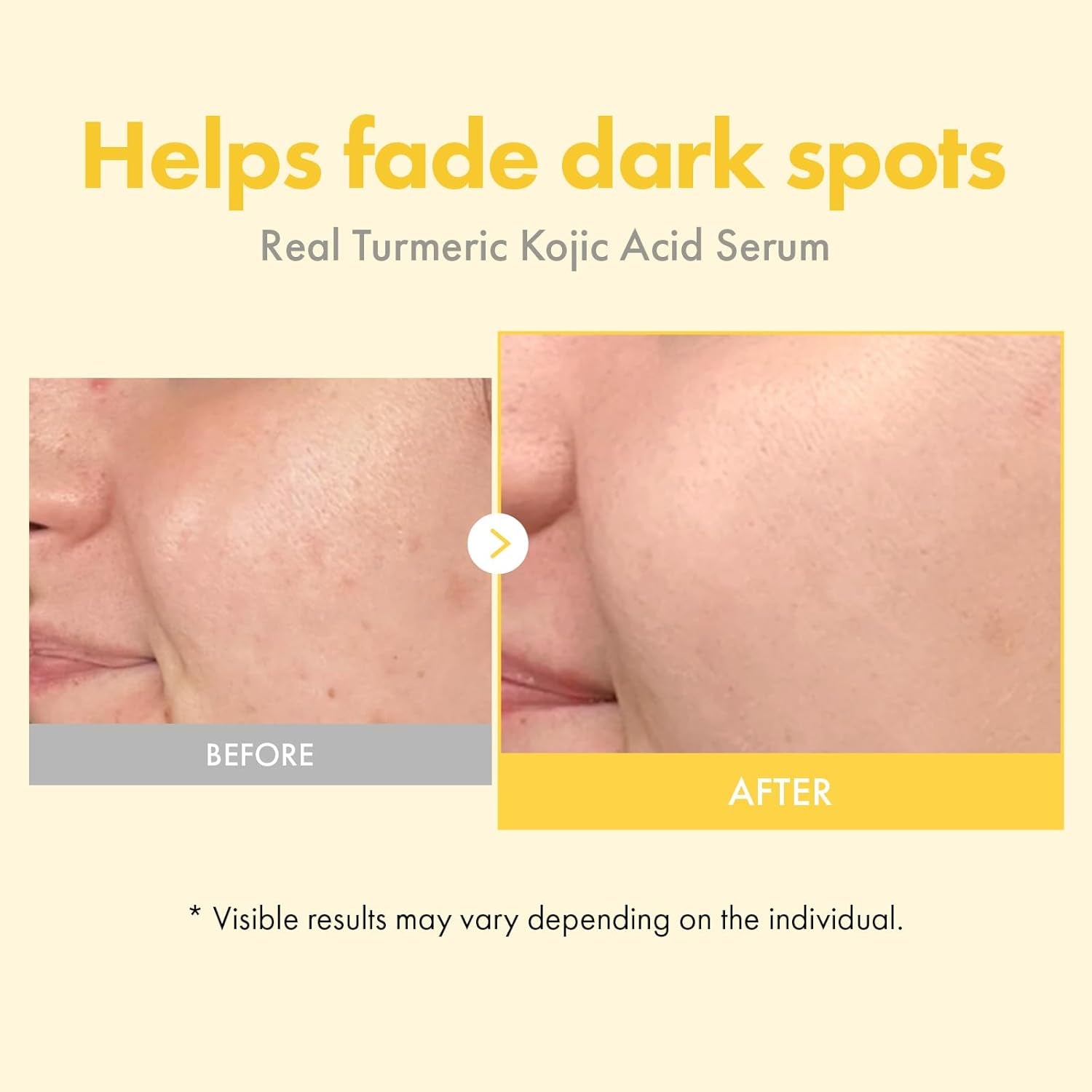 Real Turmeric Kojic Acid Serum, 7,000Ppm Kojic Acid, 1,500Ppm Turmeric, Alpha Arbutin, Astaxanthin, Glycolic Acid, Dark Spots, Freckle, Soothing, Calming, Korean Skin Care, 33Ml/1.11 Fl.Oz.