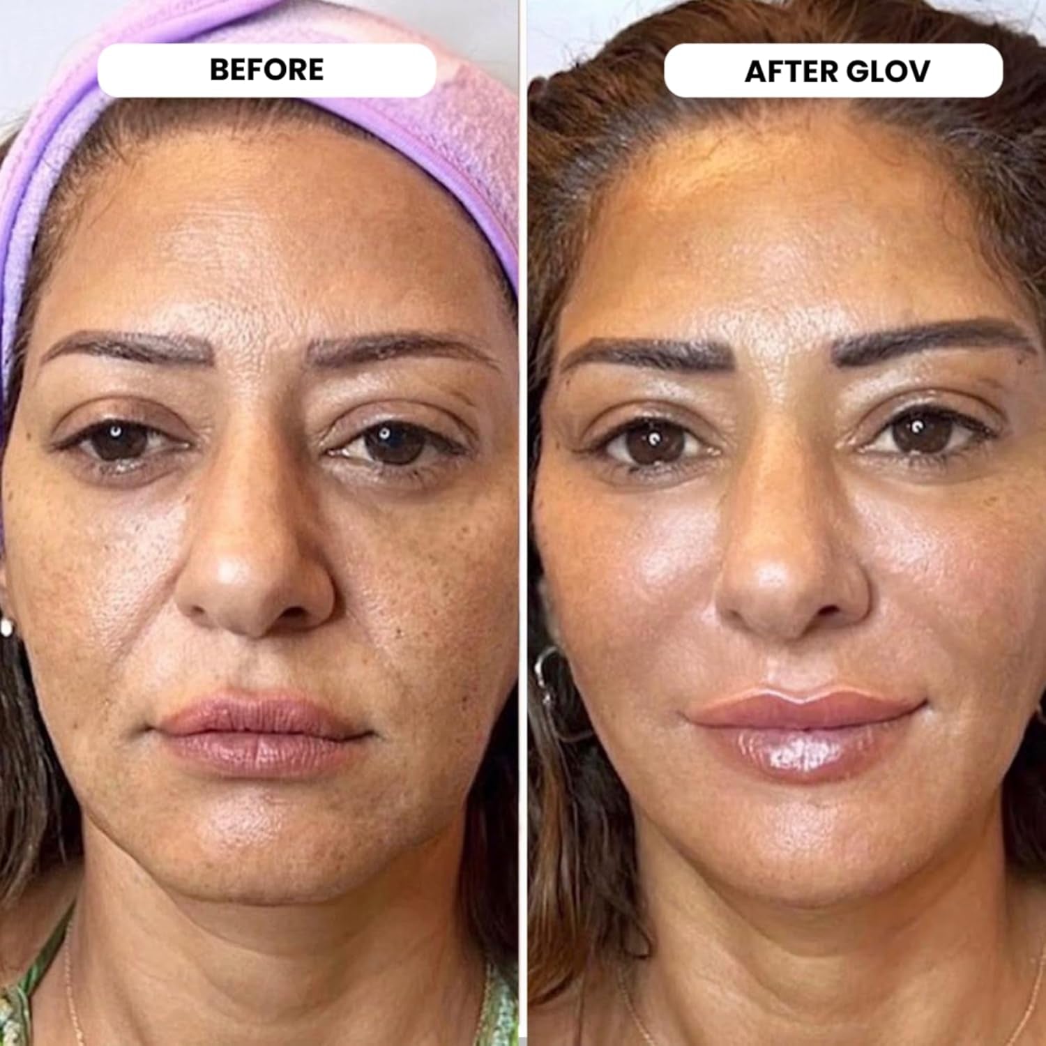 Glov Beauty Micro Infusion System - 4X Infusion Application, 12X Serums