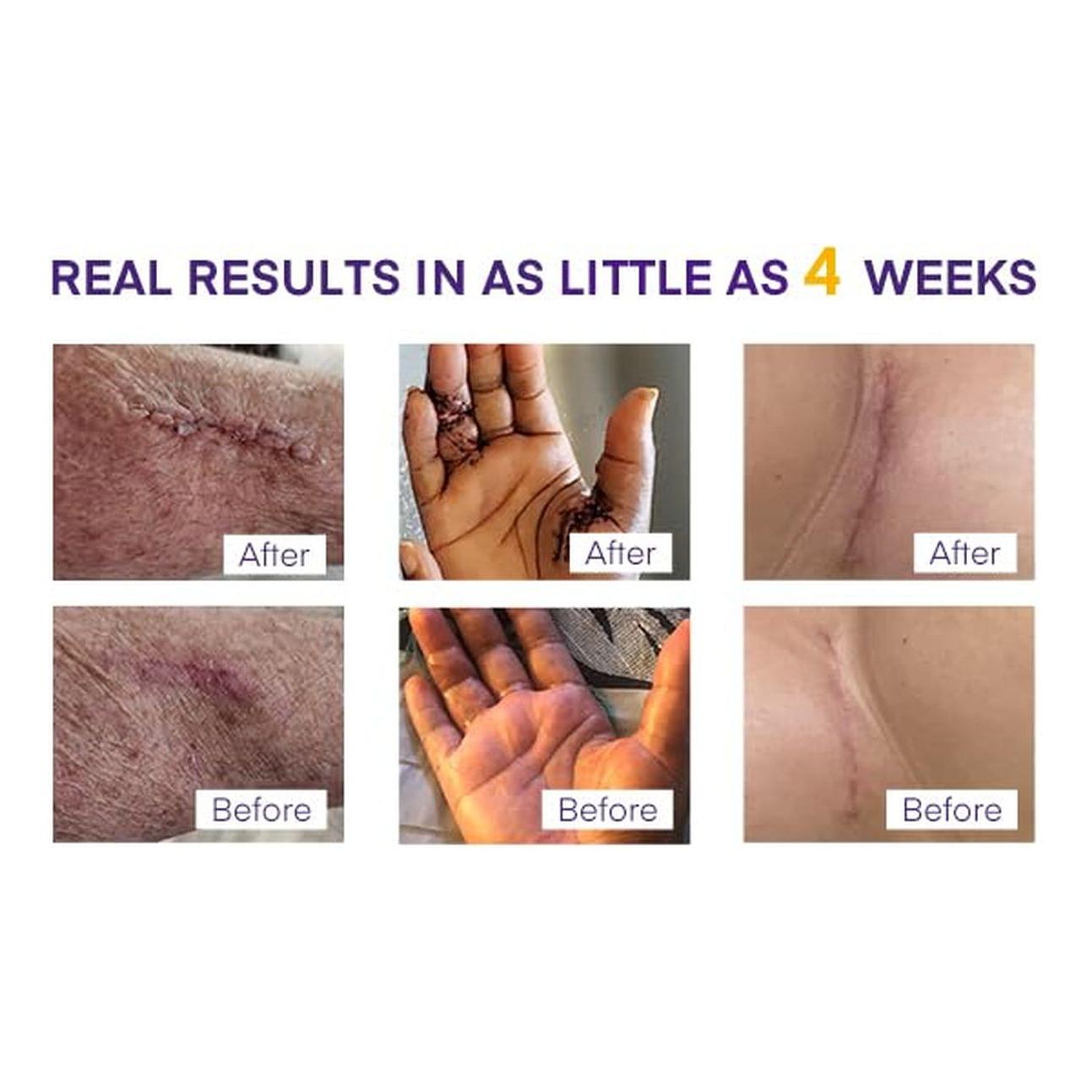 MURASAKI BEAUTY 100% Silicone Scar Gel with SPF 30 – 30g | Professional Scar Treatment for All Skin Types