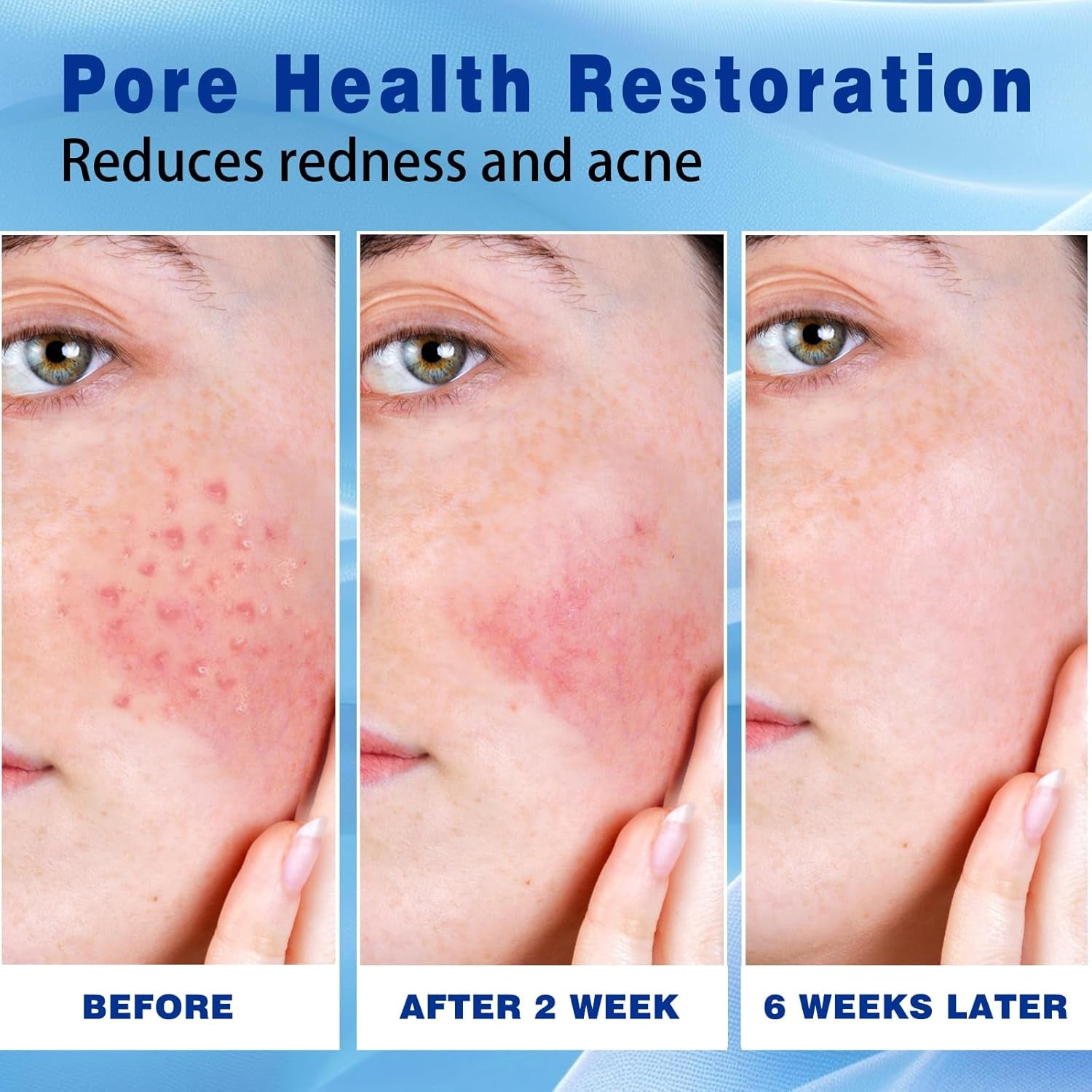 Sefralls 10% Azelaic Acid Acne Cream – 30ml | Clearer Skin, Reduced Redness & Even Tone