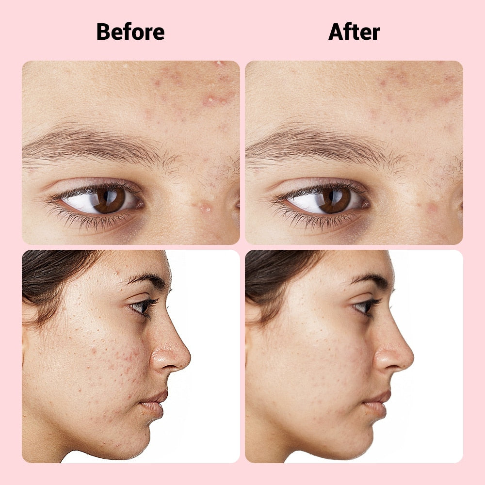 Microneedle Pimple Patch 9 Pcs - Fast Healing Repair