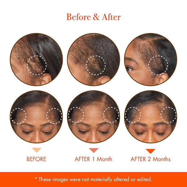 Red by Kiss Growth MD Scalp Serum – 59ml | Stimulates Hair Regrowth & Nourishes Dry Scalp