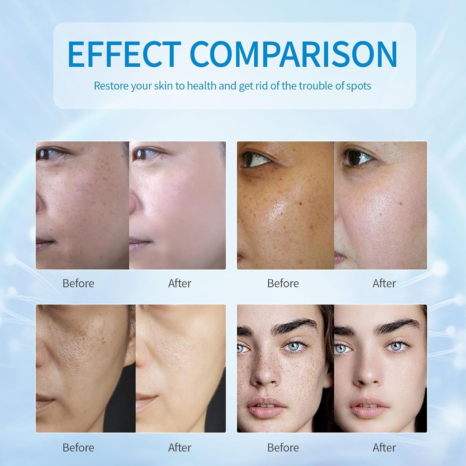 Lindesa Dark Spot Corrector – 30ml | Advanced Serum for Hyperpigmentation, Melasma, Sun Spots & Uneven Skin Tone