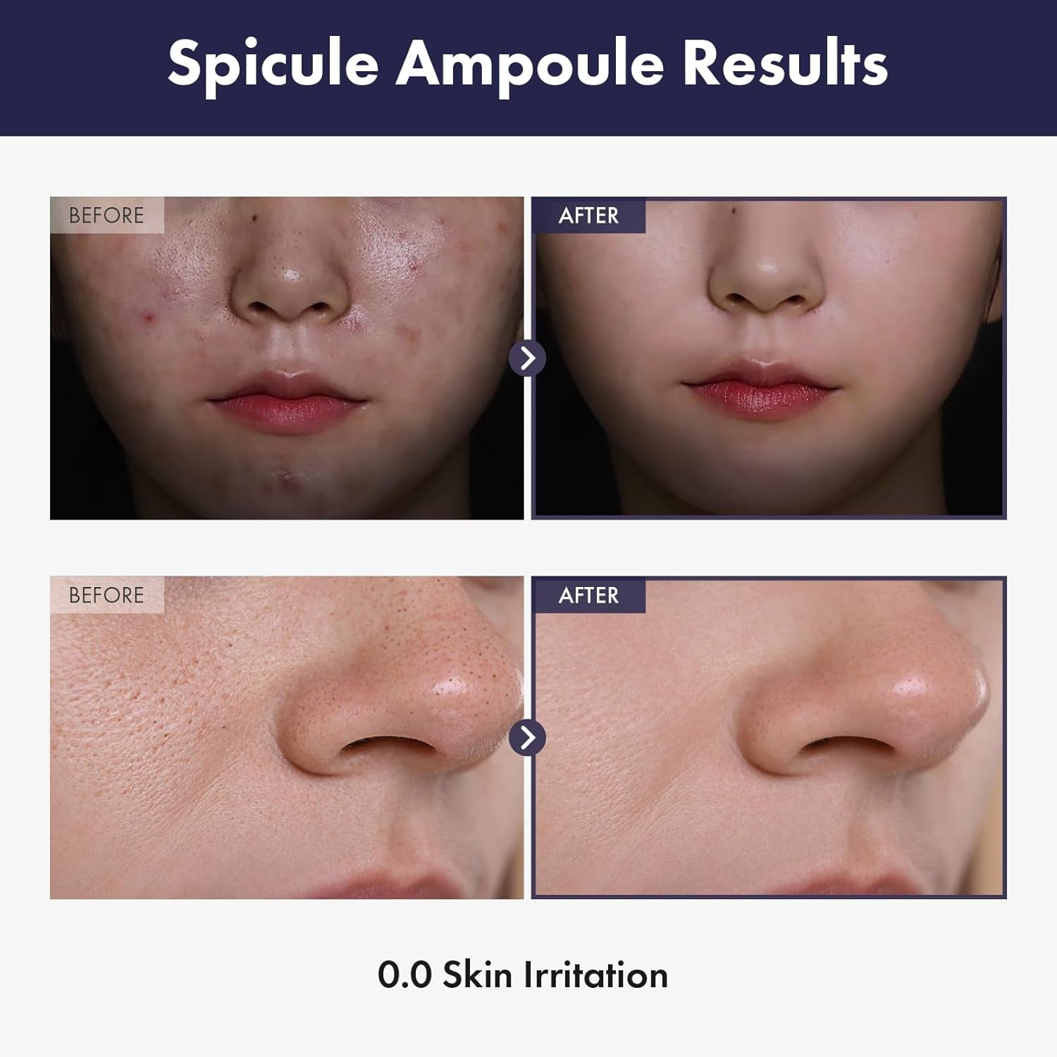 Real Spicule Ampoule with 30,000 Shots, Niacinamide, Panthenol, Liquid Skin Booster Serum, Pore Minimizer, Exfoliating, Dead Skin Cells, Skin Texture, Korean Skincare, 30Ml, 1.01 Fl. Oz.