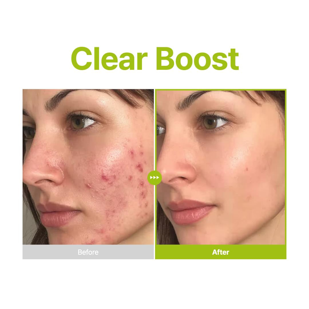 Azelaic Acid 10% + Kojic Acid + Tea Tree Facial Serum | for Acne & Marks, Breakouts | High-Level Azelaic Acid 10% | Korean Skincare, 30Ml 1.01 Fl.Oz