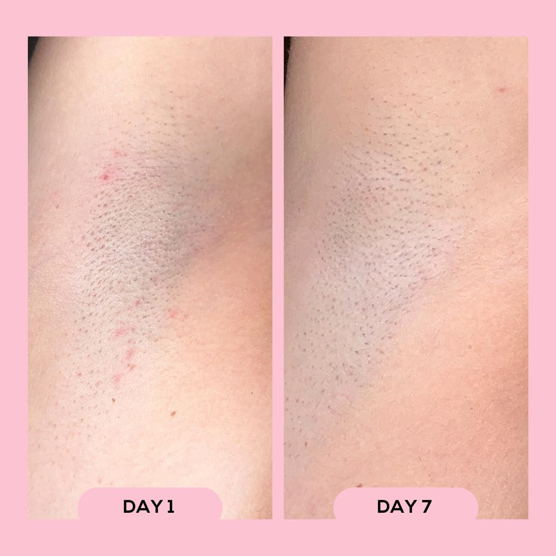 Megababe Après Shave Ingrown & Razor Bump Roll-On Solution – 88ml | Award-Winning Ingrown Hair Treatment for Smooth, Bump-Free Skin