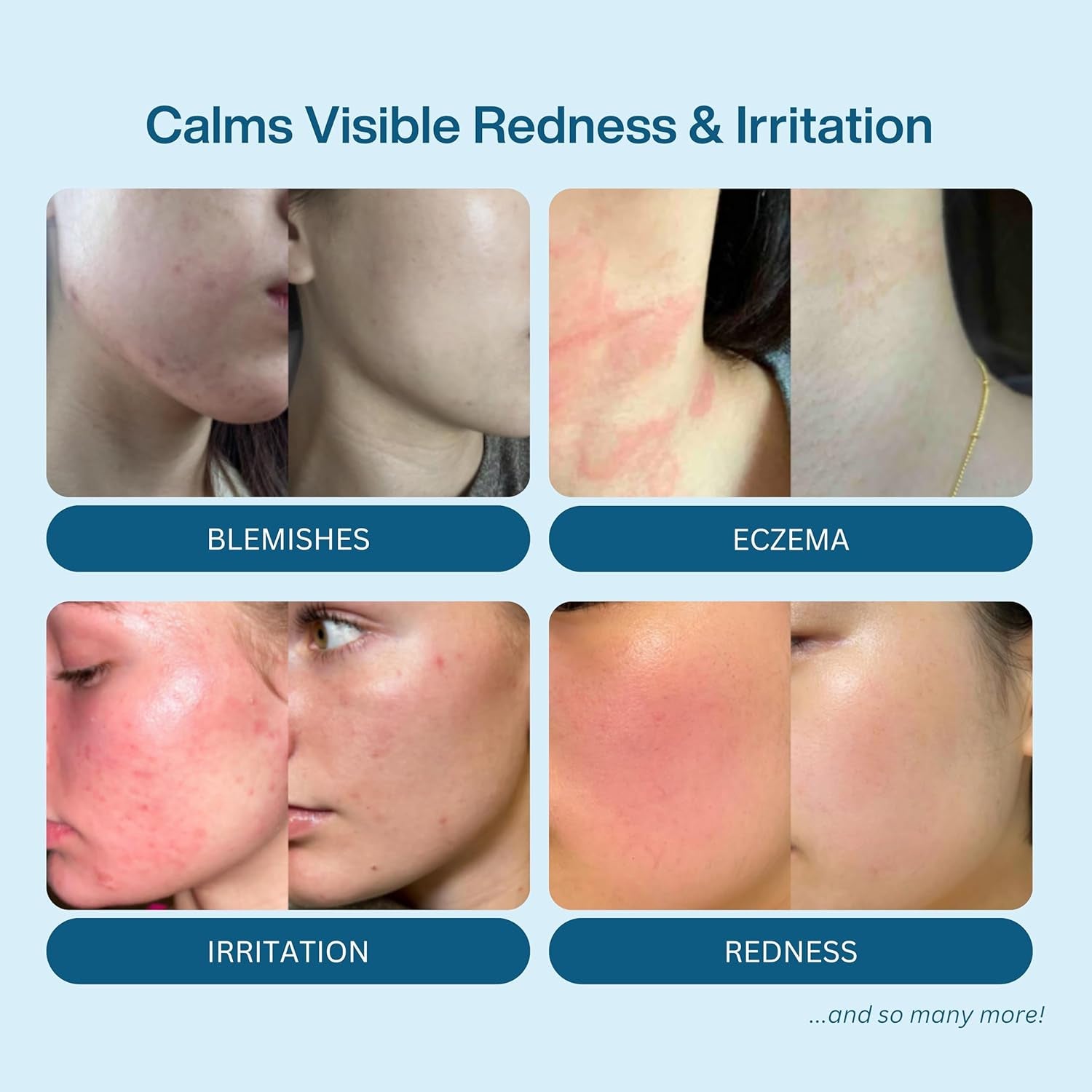 Honeydew Labs Hypochlorous Acid Face Spray – Cleanse & Soothe - 200ml