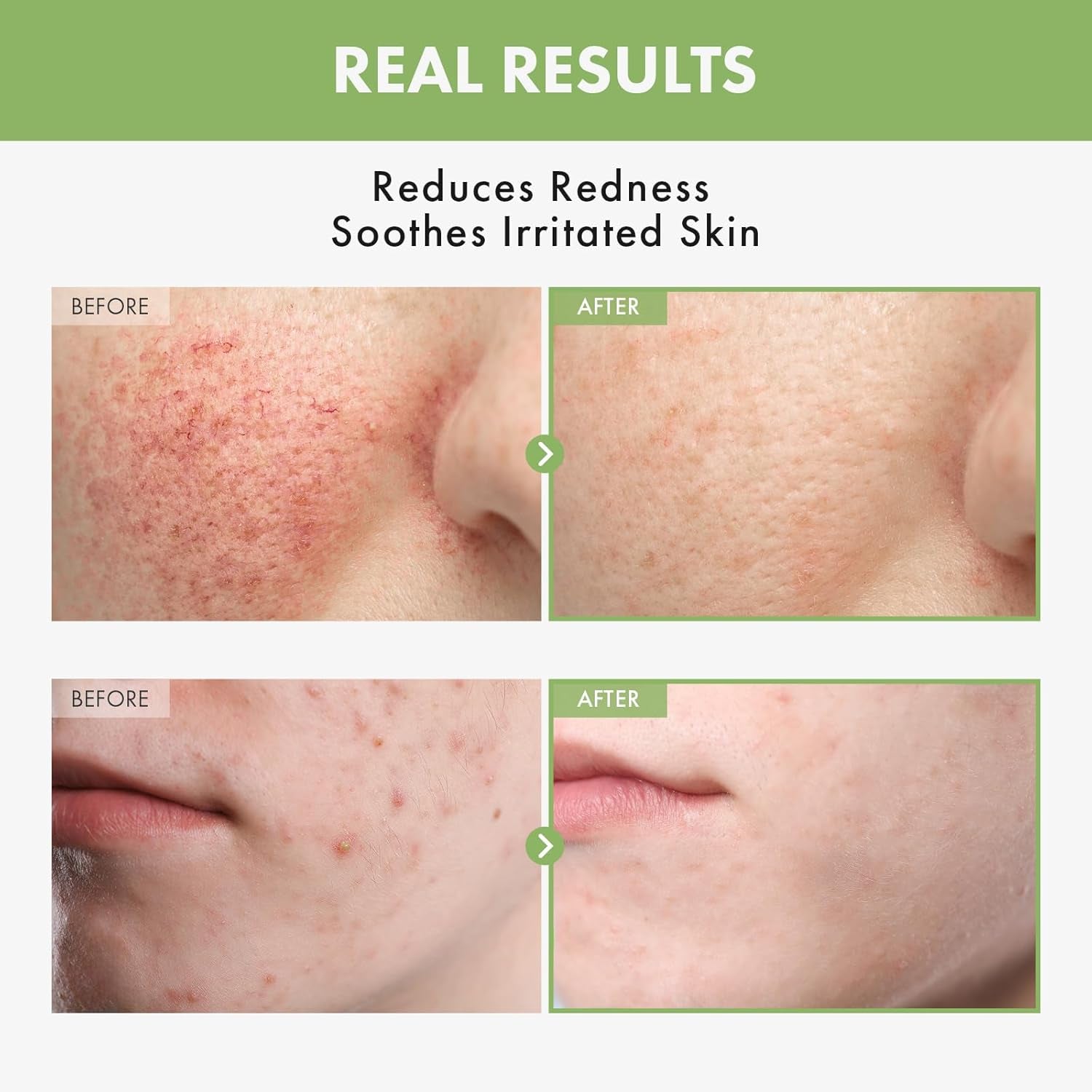 Heartleaf Face Toner with 970,200Ppm Heartleaf Water, Centella, Hyaluronic Acid, Witch Hazel, Trouble Care, Acne-Prone, Calming, Hydrating, Purifying, Korean Skin Care, 250Ml, 8.45 Fl.Oz.