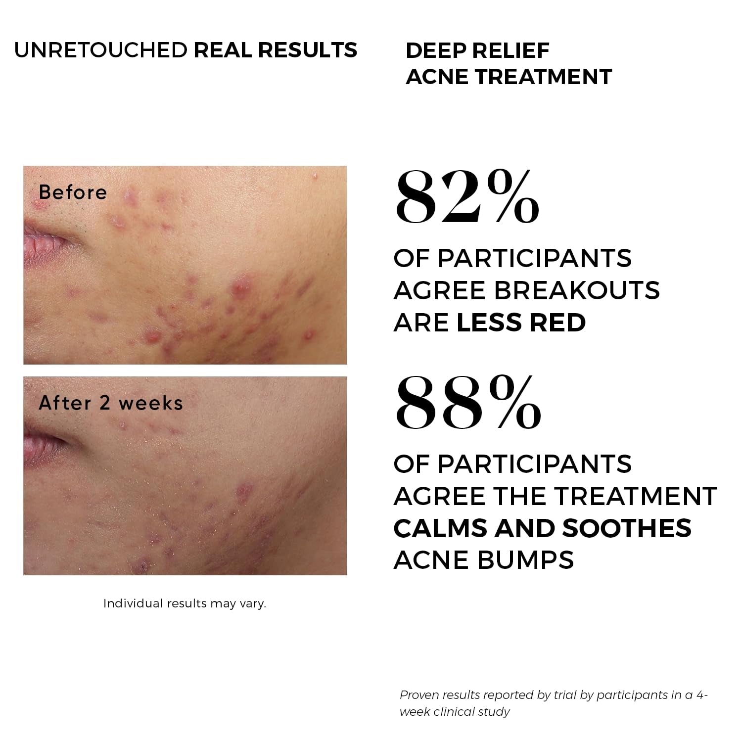 Beauty Facial Extreme Acne Treatment Pads – 60 Pads | Salicylic, Glycolic & Lactic Acid Exfoliating Pads for Face & Body