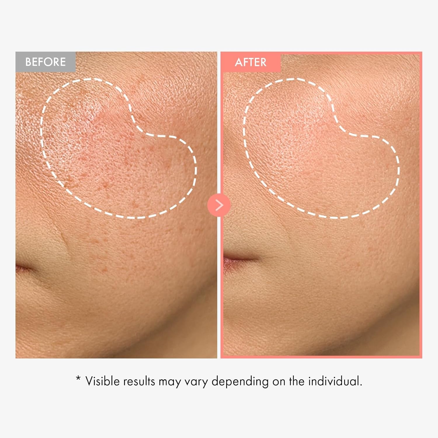 Peach 80 Niacin Serum, 5% Niacinamide, Alpha-Arbutin, Vitamin B12, Glass Skin, Hydrating Face Serum for Dark Spots, Pore Minimizer, Uneven Tone, Dullness, Korean Skincare, 33Ml/1.11 Fl. Oz.