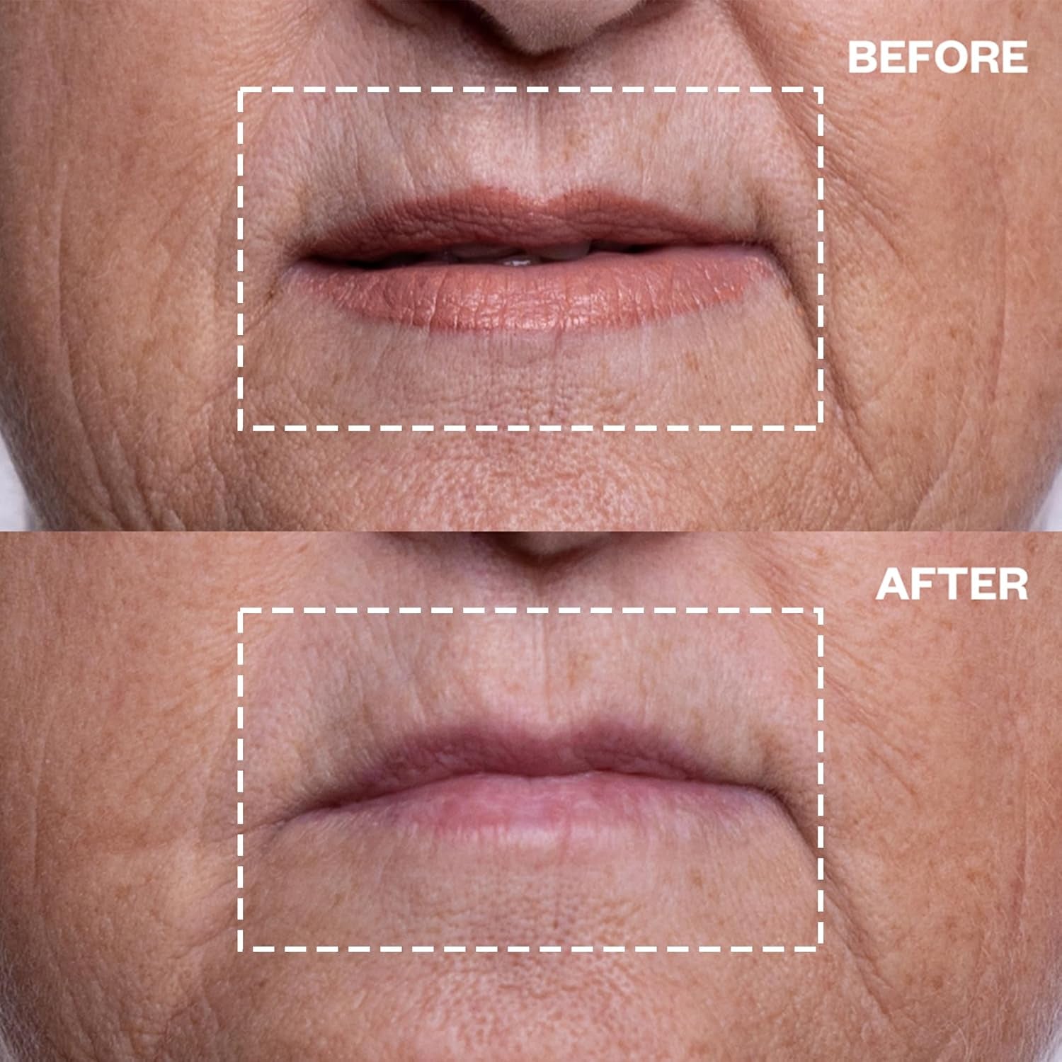 Wrinkles Schminkles Mouth & Lip Wrinkle Patches – 2 Packs | Reusable Silicone Patches for Smile Lines & Marionette Wrinkles