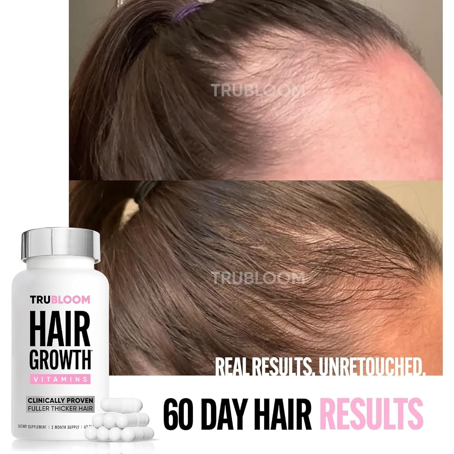 St. Tropica Tru Bloom Hair Growth Vitamins – 62 Capsules | Clinically Proven for Thicker, Fuller Hair in 60 Days