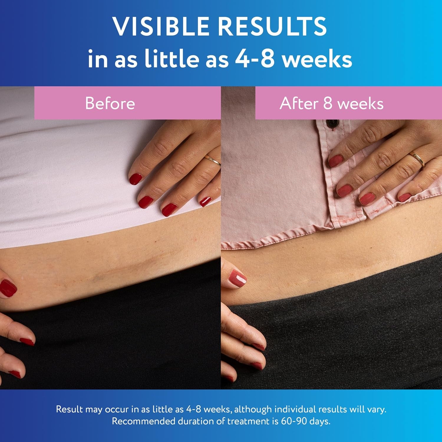 Advanced Silicone Scar Sheets for C-Section, Reusable Strips (1.5” X 7”) for Hypertrophic and Keloid Scars from C-Section & Other Surgeries, 4 Sheets