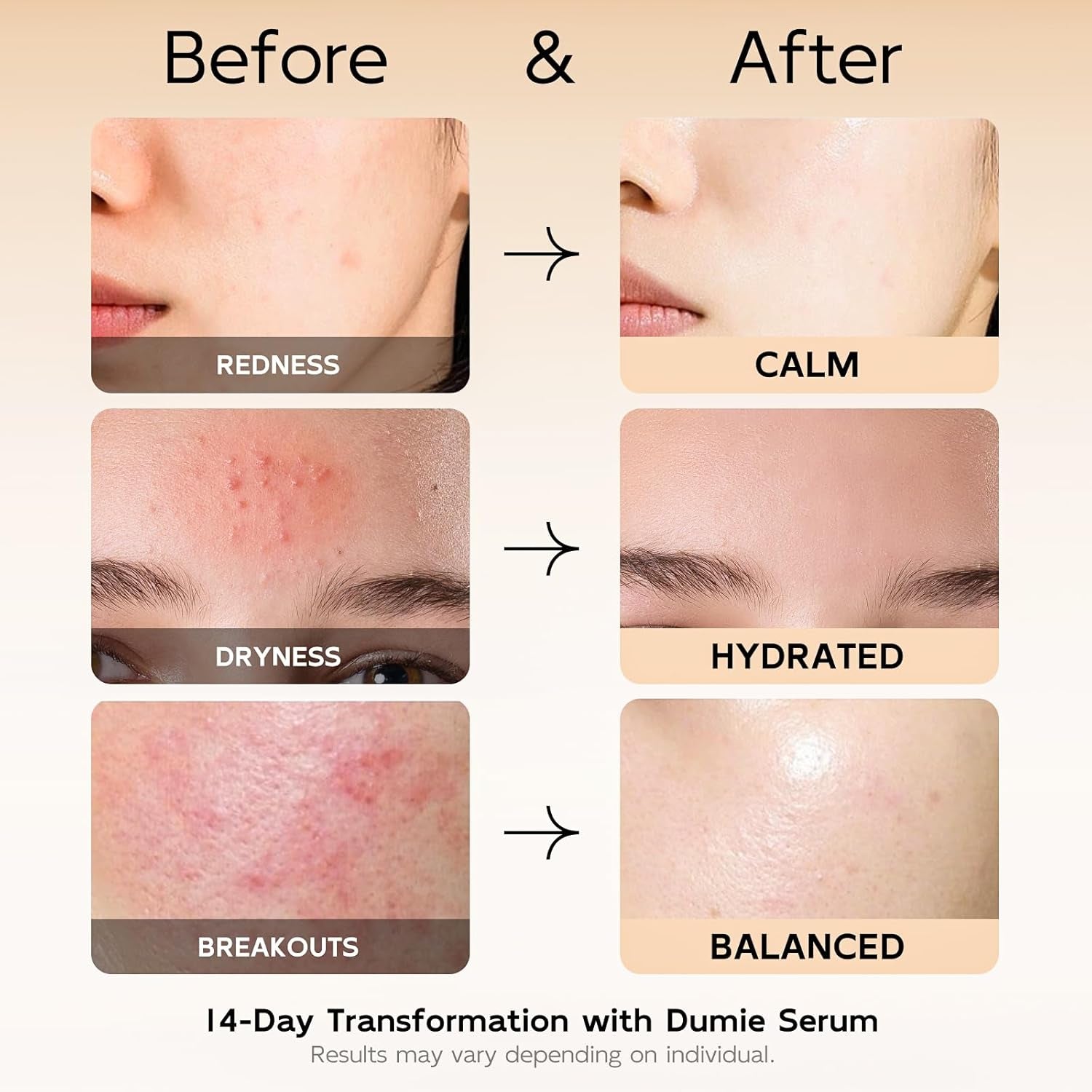Dumie 10% Azelaic Acid Redness Soothing Serum – 30ml | Calms Redness & Strengthens Skin Barrier