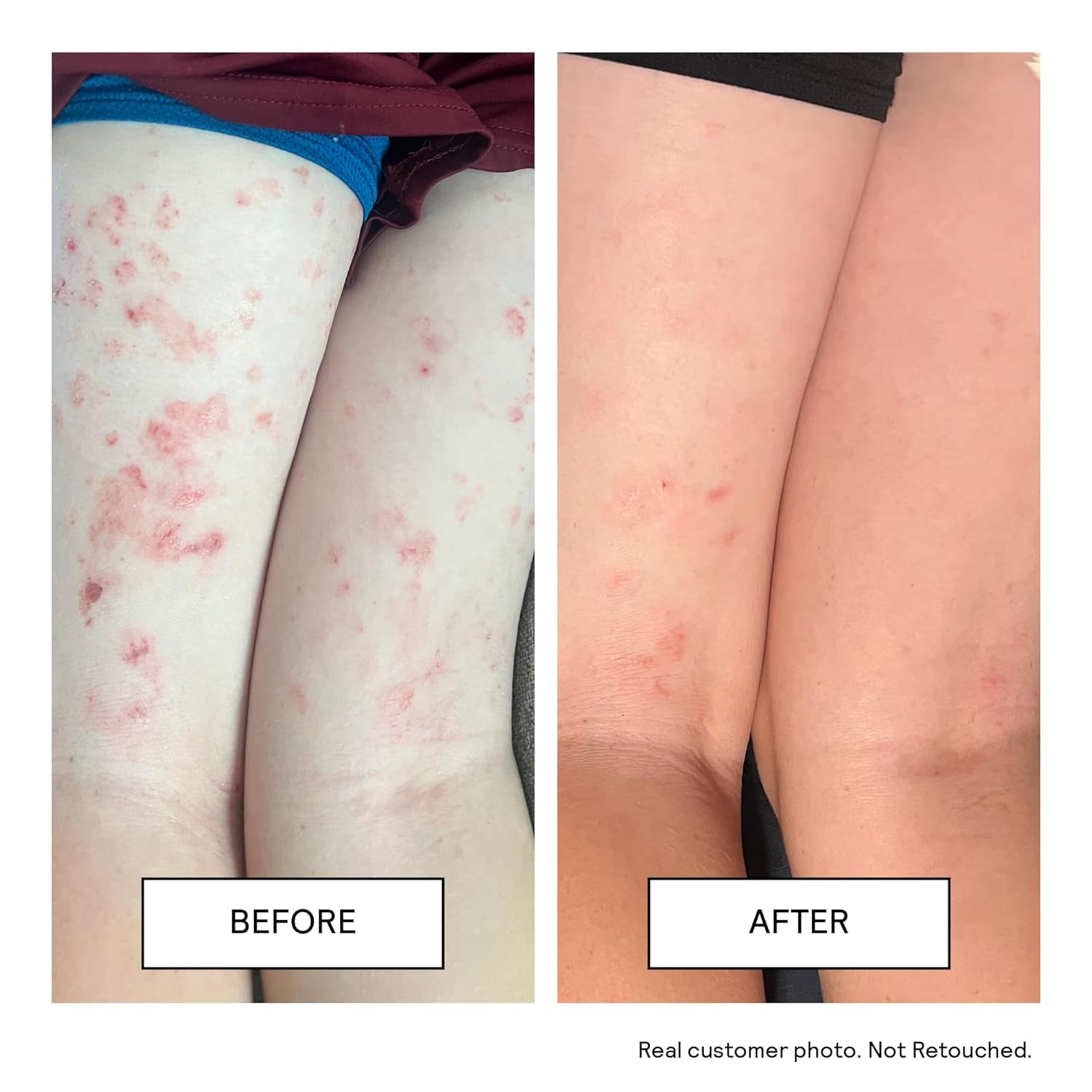 Moisturizing Cream - Facial Moisturizer & Body Cream for Sensitive Skin and NEA Approved for Eczema Relief - Ceramides & Hyaluronic Acid with No Common Irritants