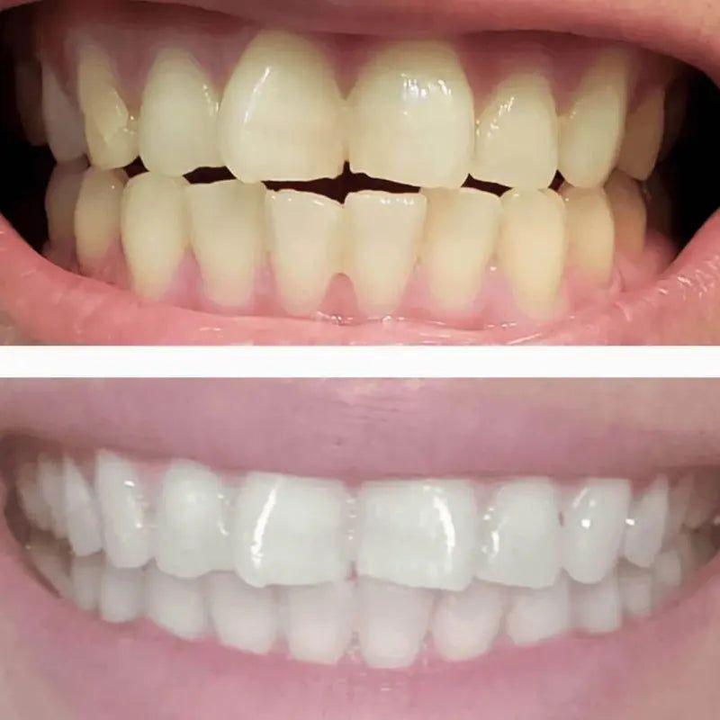 SNOW Diamond Wireless Teeth Whitening Kit