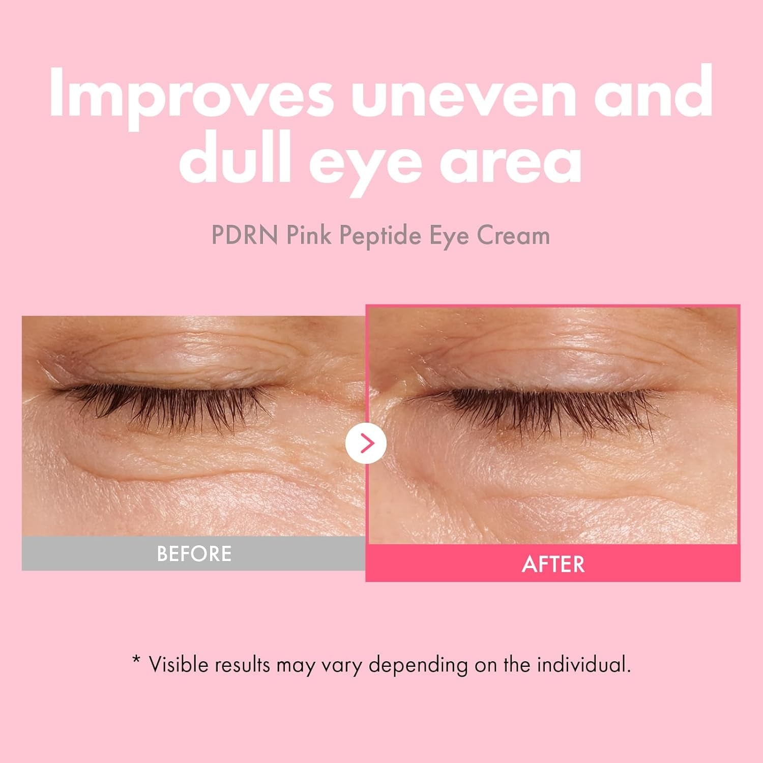PDRN Pink Peptide Eye Cream with Salmon DNA PDRN 5,000Ppm, anti Aging Formula with Caffeine & Liposome Retinol for Fine Lines, Dark Circles and Wrinkles, Korean Skincare, 30Ml / 1.01 Fl.Oz.