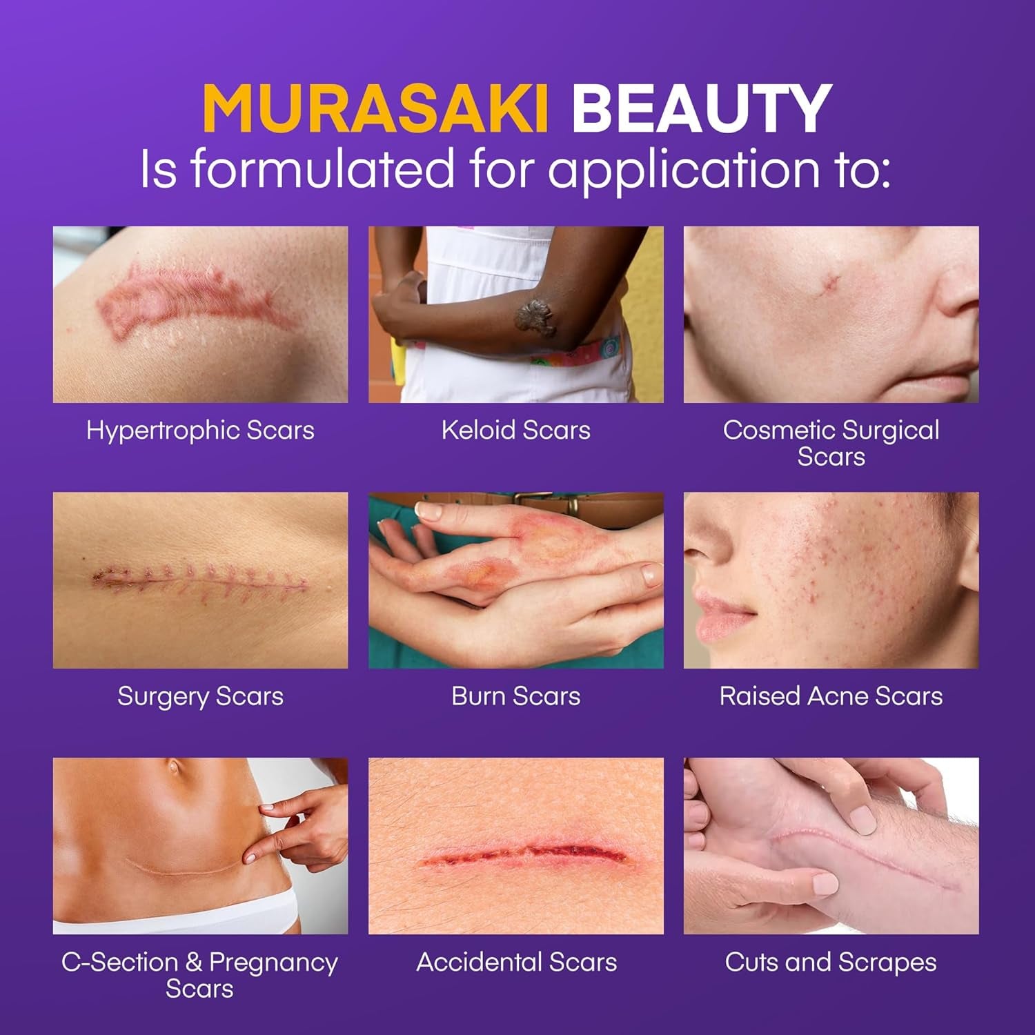 MURASAKI BEAUTY 100% Silicone Scar Gel with SPF 30 – 30g | Professional Scar Treatment for All Skin Types