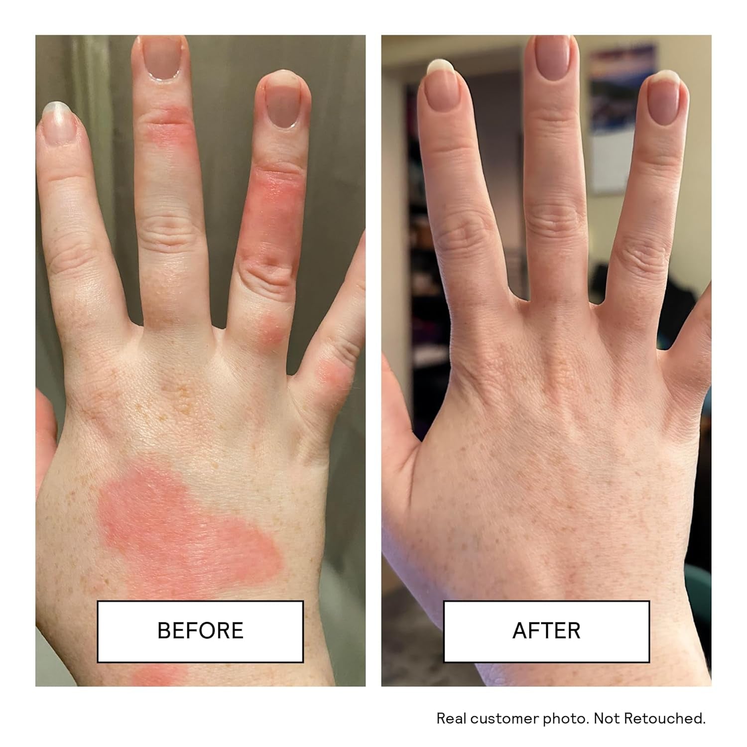 Moisturizing Cream - Facial Moisturizer & Body Cream for Sensitive Skin and NEA Approved for Eczema Relief - Ceramides & Hyaluronic Acid with No Common Irritants