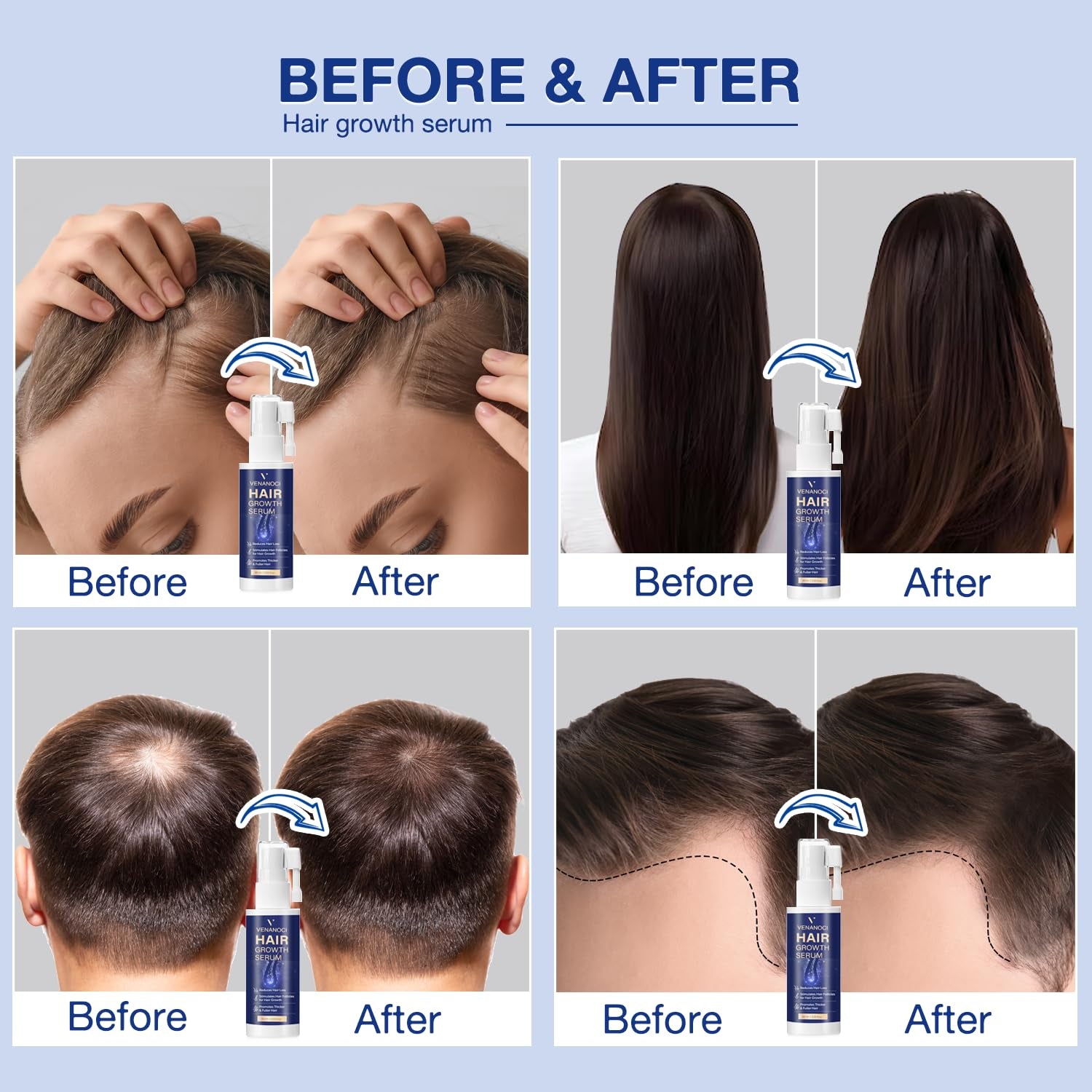 Venanoci Hair Growth Serum – 60ml | Rosemary, Rice Water & Biotin for Thicker, Fuller Hair