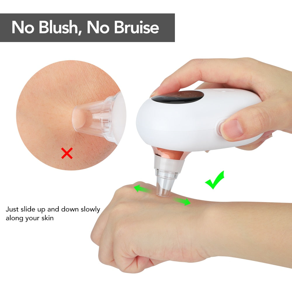 Blackhead Remover Vacuum & Diamond Microdermabrasion Device – Deep Pore Cleaner, Acne Extractor & Facial Skin Rejuvenation Tool