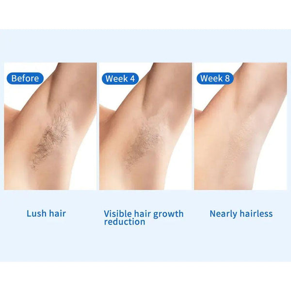 【48%OFF】IPL At-Home Ice-Cooling Laser Hair Removal Device with Sapphire Technology for Women and Men, Effortless and Comfort IPL Hair Removal Device for Body, Face, Bikini Line, Legs, Armpit, Unlimited Flashes, FDA Cleared