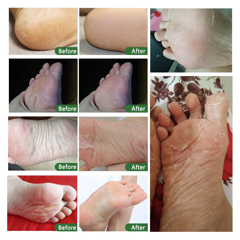 ALIVER Exfoliating Foot Mask – Lavender – 5 Pack | Peels Dead Skin for Baby-Soft Feet