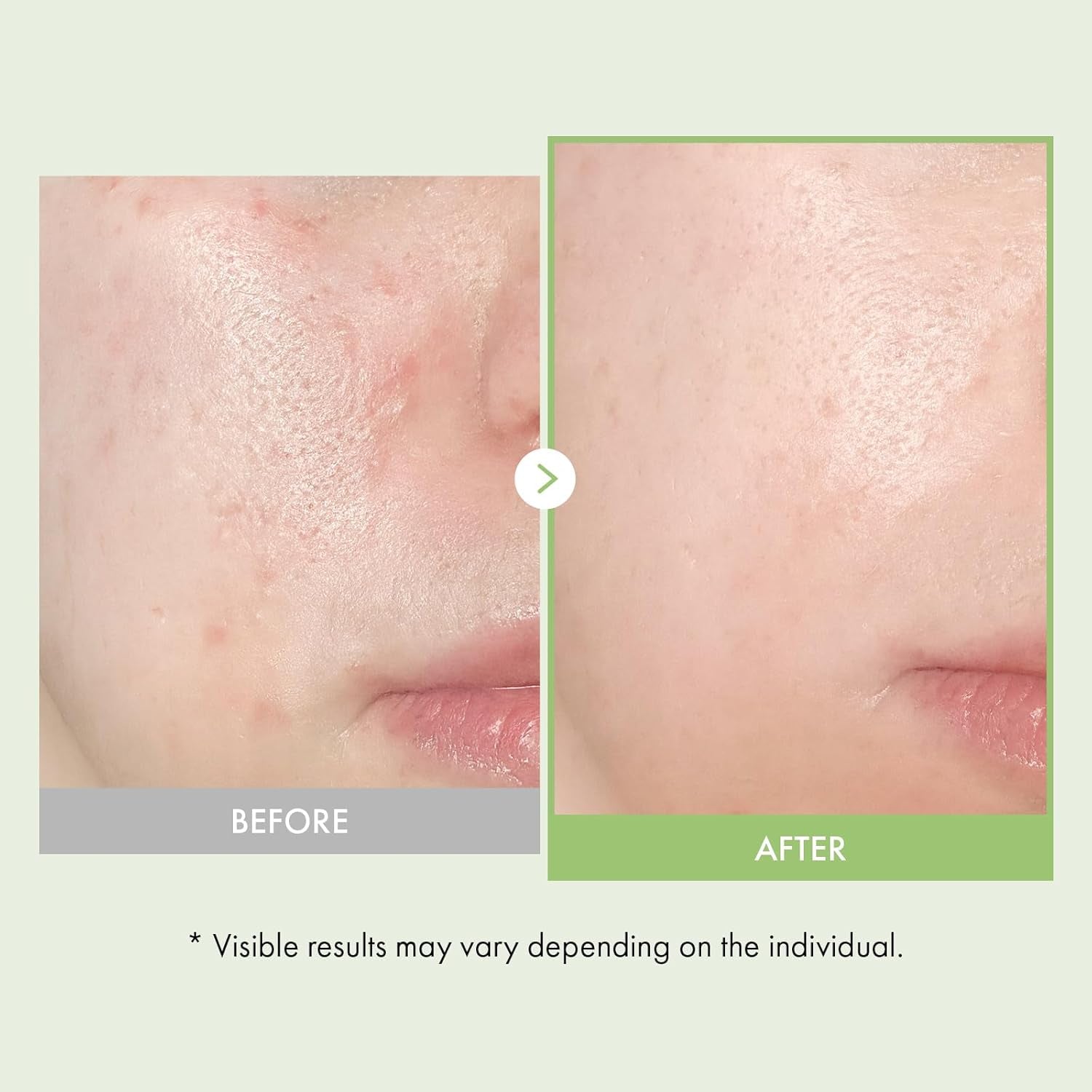 Real Relief Noni Ampoule, 701,518Ppm Noni Leaf Juice, Korean Skincare Calming Serum, Dark Spots & Fine Lines, Hydration, Moisturizing, anti Aging, Glass Skin Glow, 33Ml / 1.11 Fl. Oz.