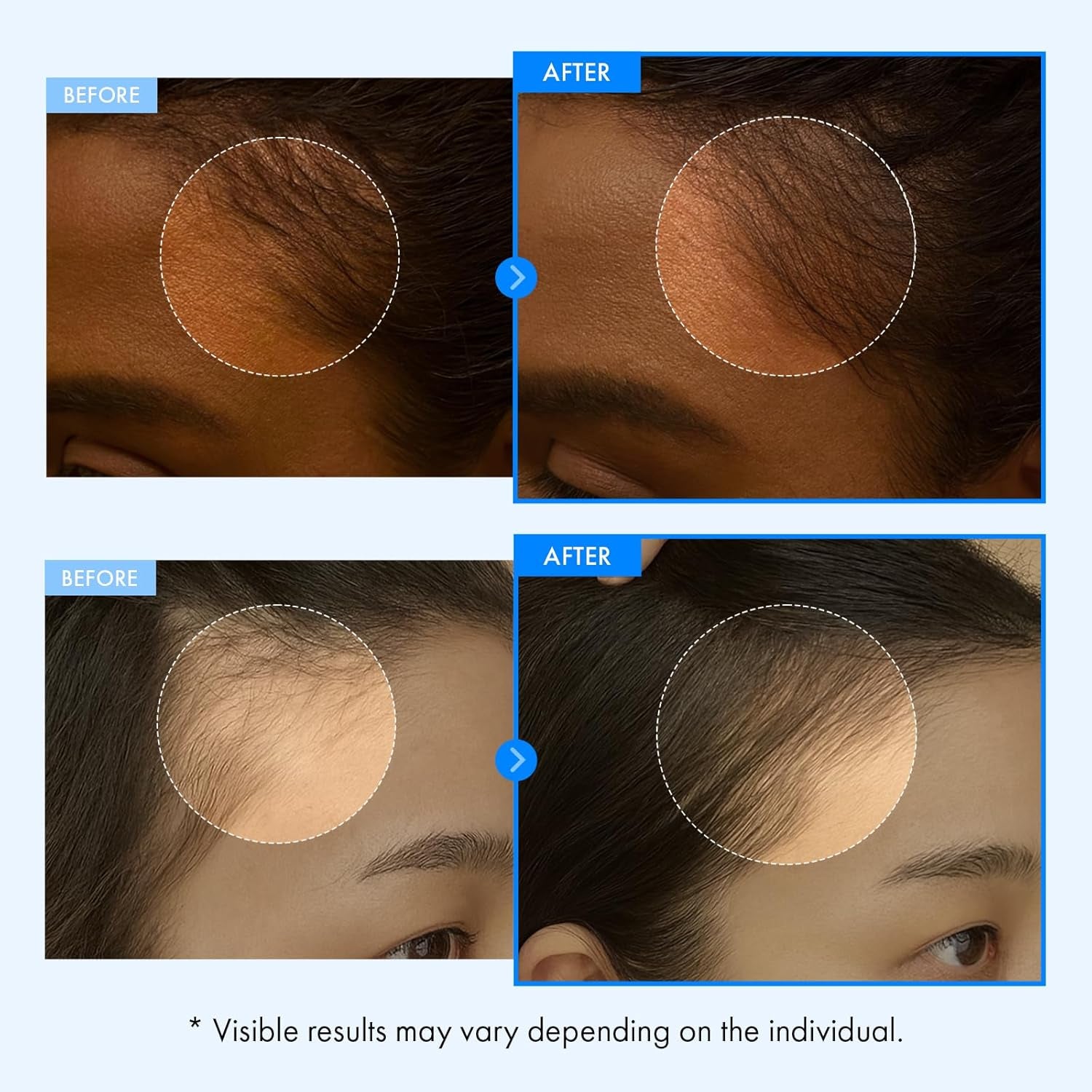 Real Relief Rolling Serum, Hair Growth Serum Roll on with Biotin, Caffeine, Panthenol, Menthol, Soothes Itchy, Flaky Scalp, Non-Greasy, Lightweight, Korean Skincare, 20Ml / 0.67 Fl. Oz.