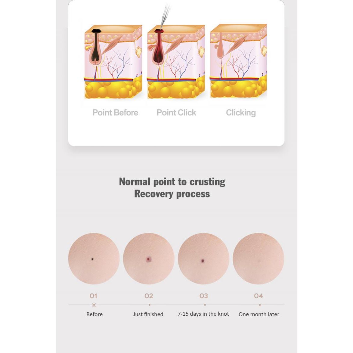 Plasma Pen Fibroblast Laser Pen – Mole Removal Precision