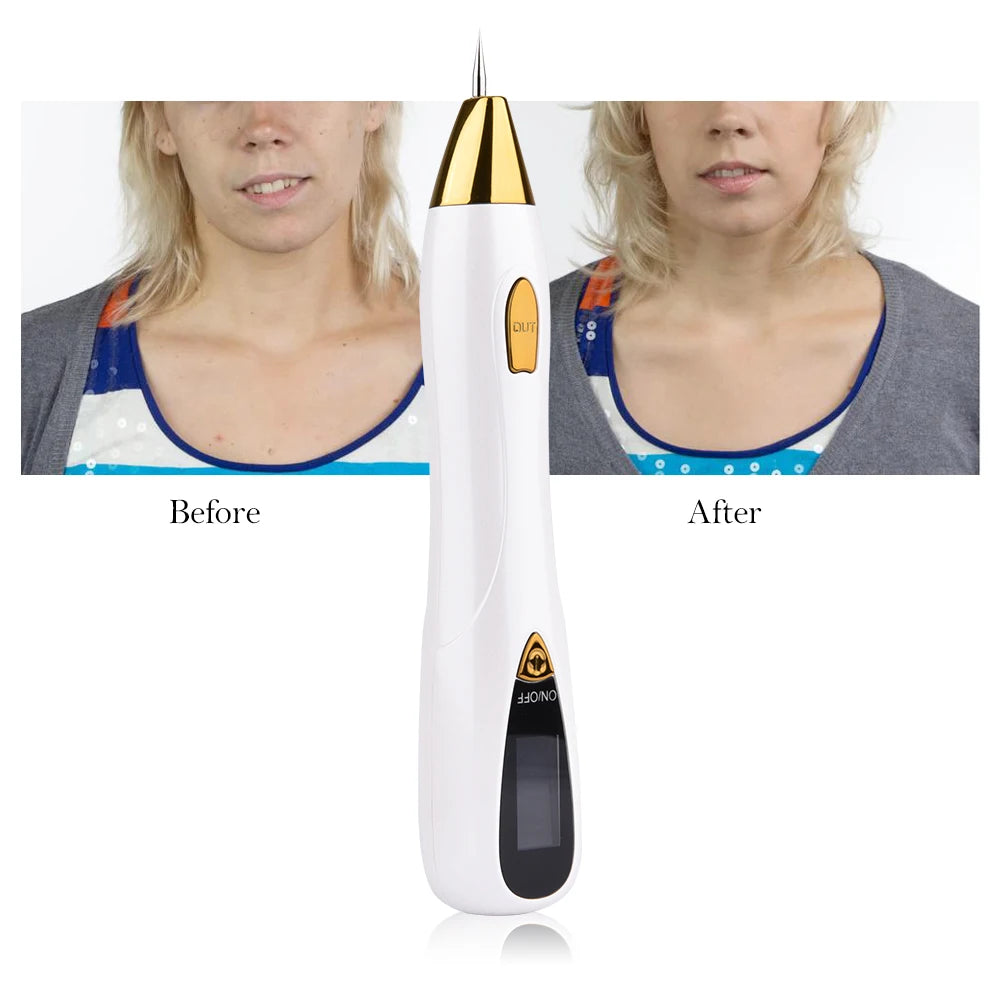 Skin Care Laser Mole & Freckle Removal Pen – LCD Display Spot Remover for Warts, Dark Spots & Tattoo Fading
