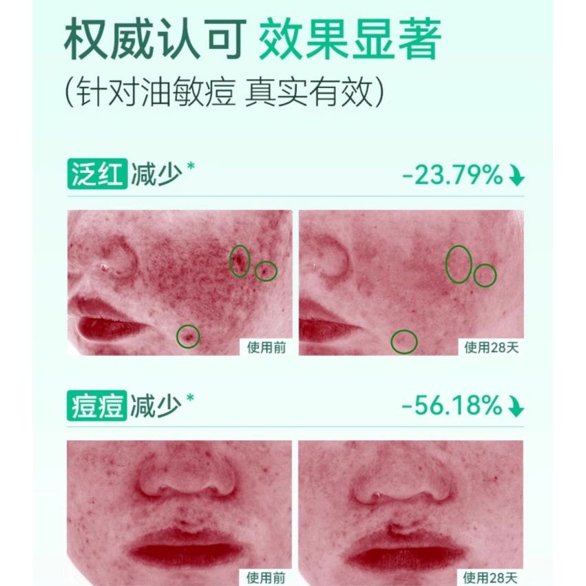 Yin Shi Gentle Acne Treatment Serum 15ml – Calming Clarification Sensitive Skin