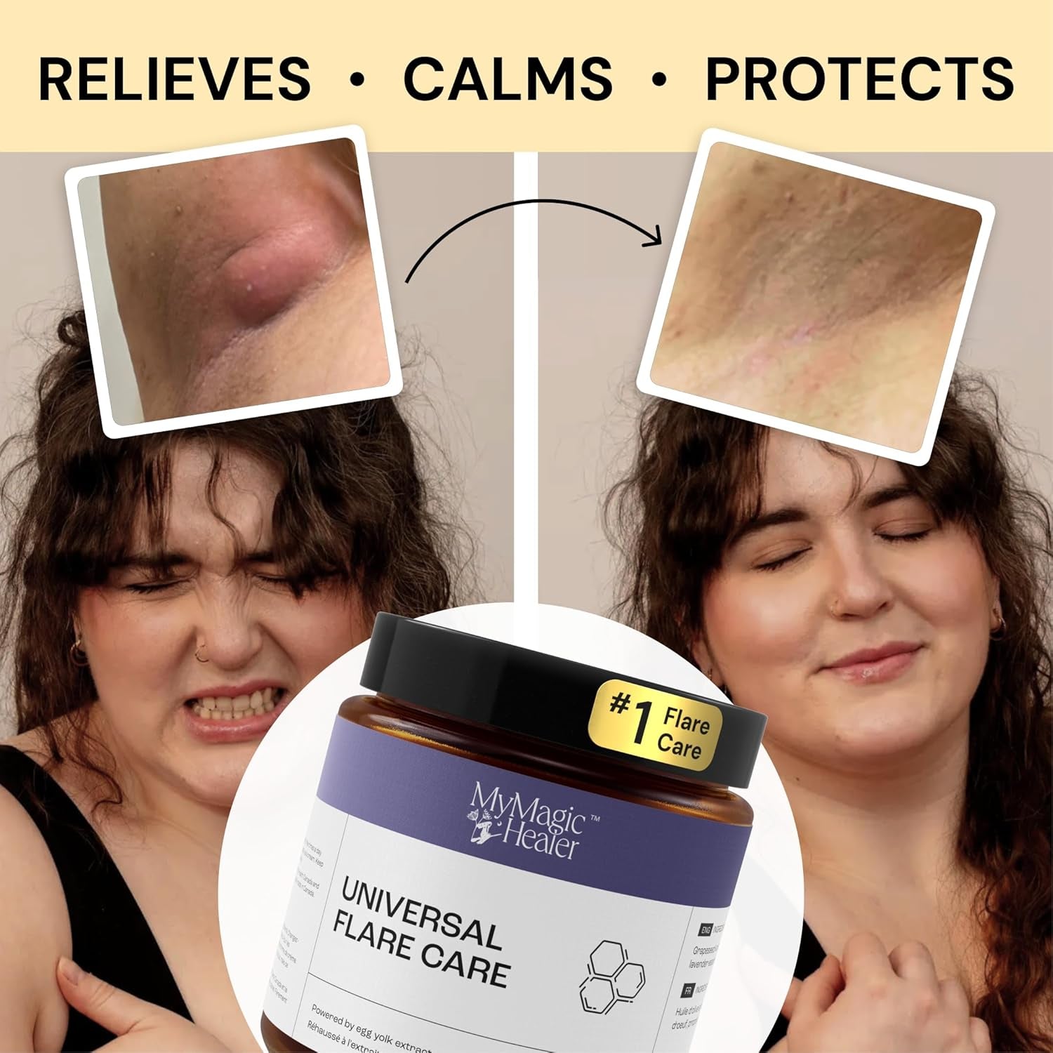 MyMagicHealer Universal Flare Care – 4oz (113g) | Natural Relief for HS, Boils, Abscesses & Skin Flare-Ups