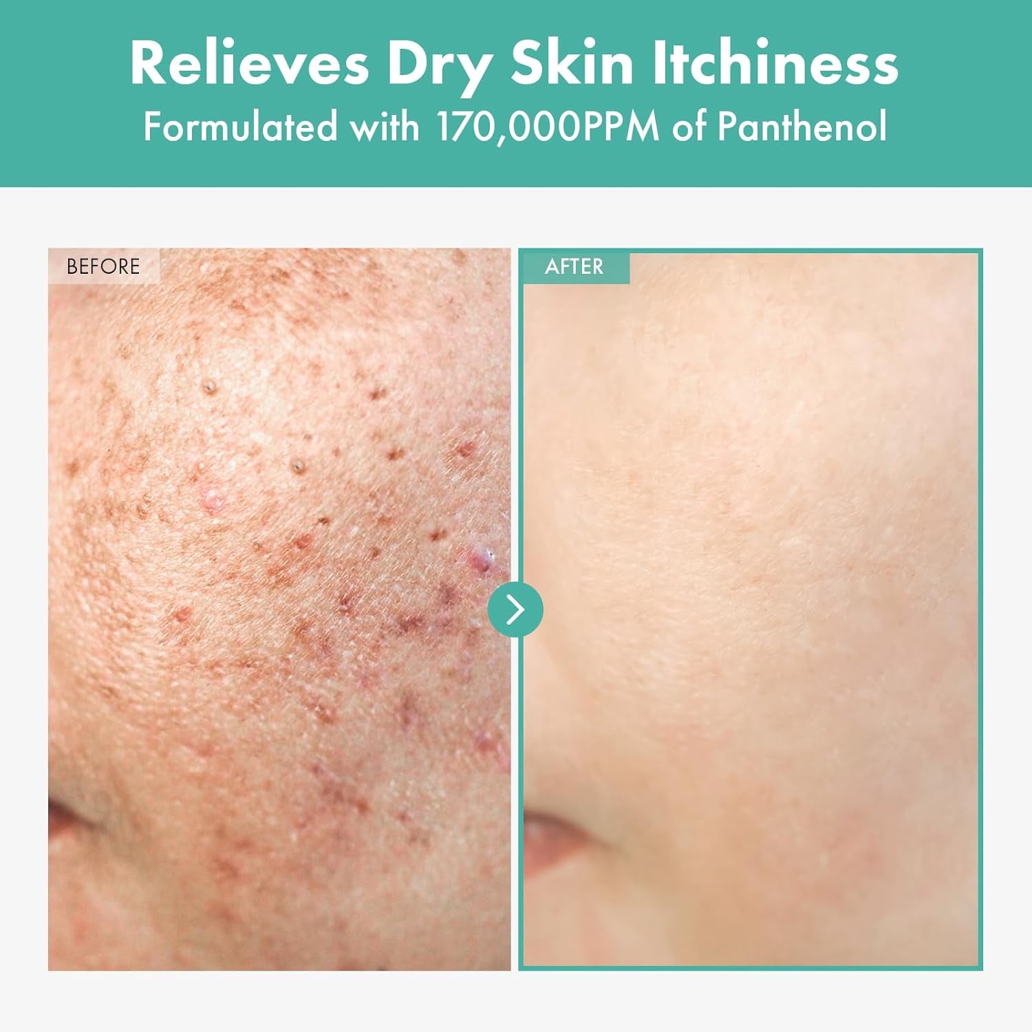 Dexpanthenol Cream, 170,000Ppm B5 Panthenol, Madecassoside, Centella Asiatica for Skin Barrier Repair, Facial Moisturizer, Soothing, Hydrating, Korean Skincare, 60Ml, 2.02 Fl. Oz.