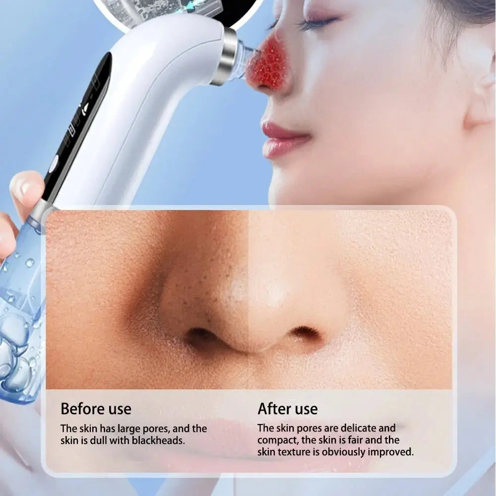 Blackhead Remover Device - Glam Global UK